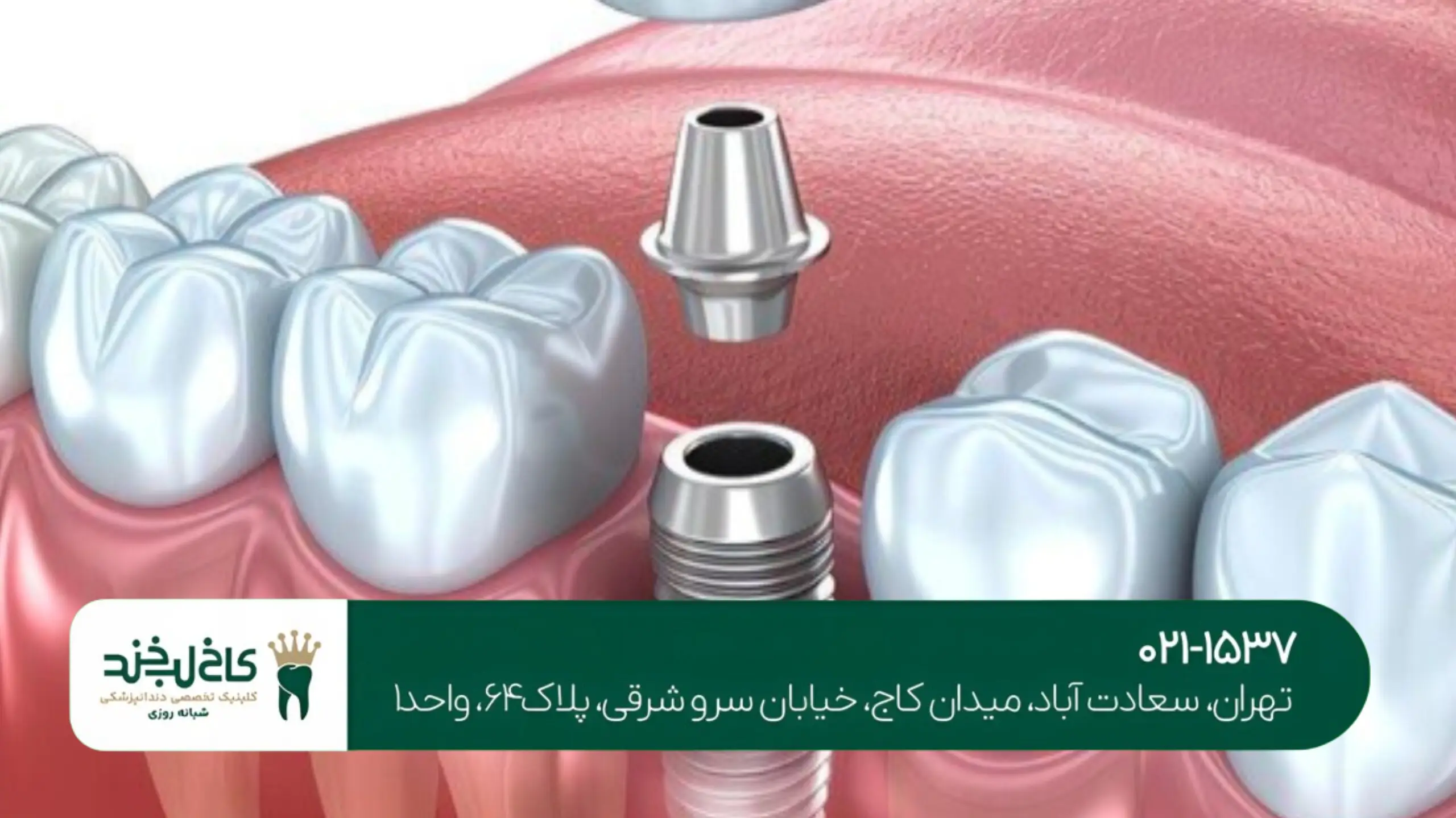 ترمیم لمینت لبپر شده