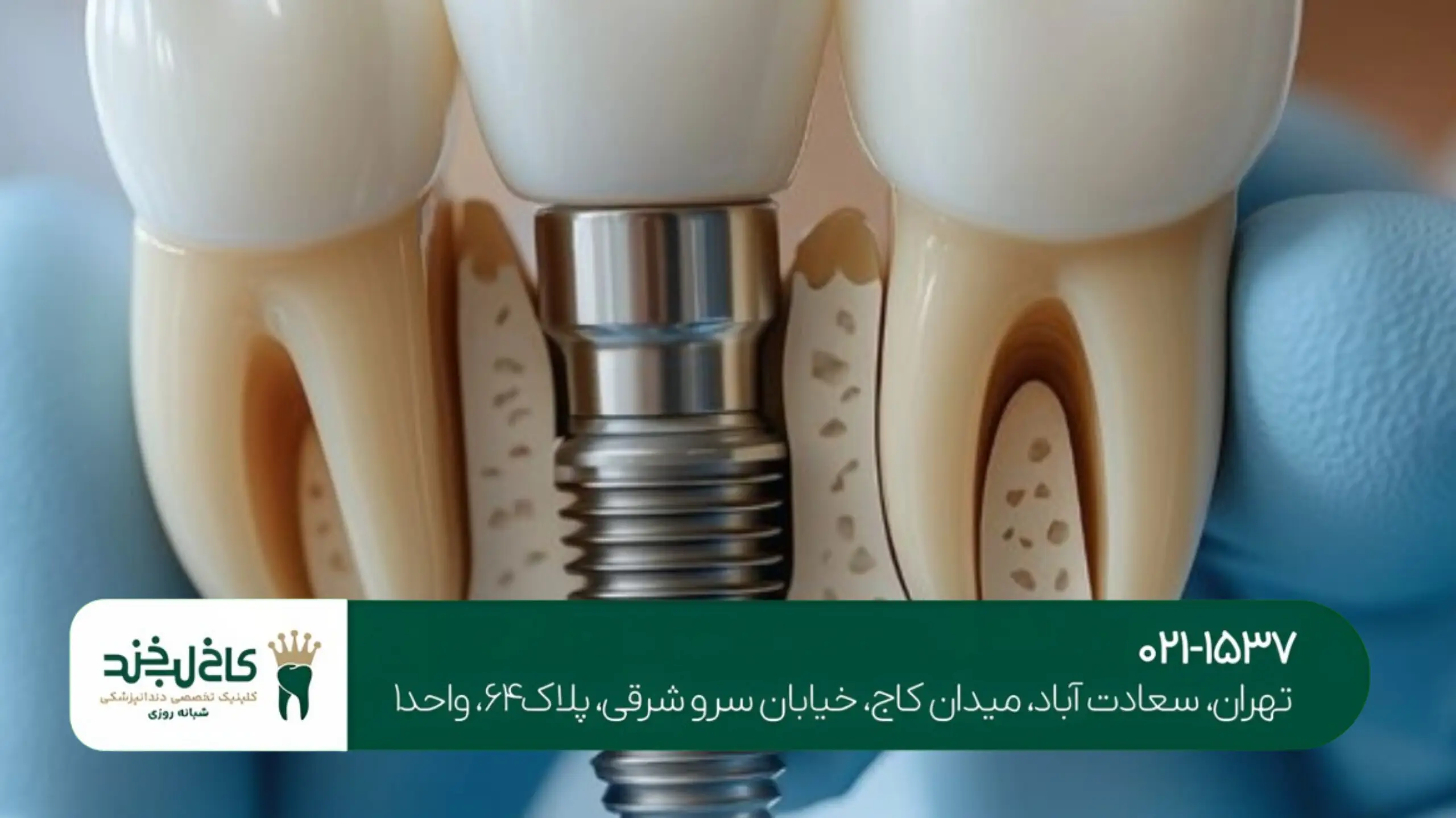 ترمیم لمینت لبپر شده