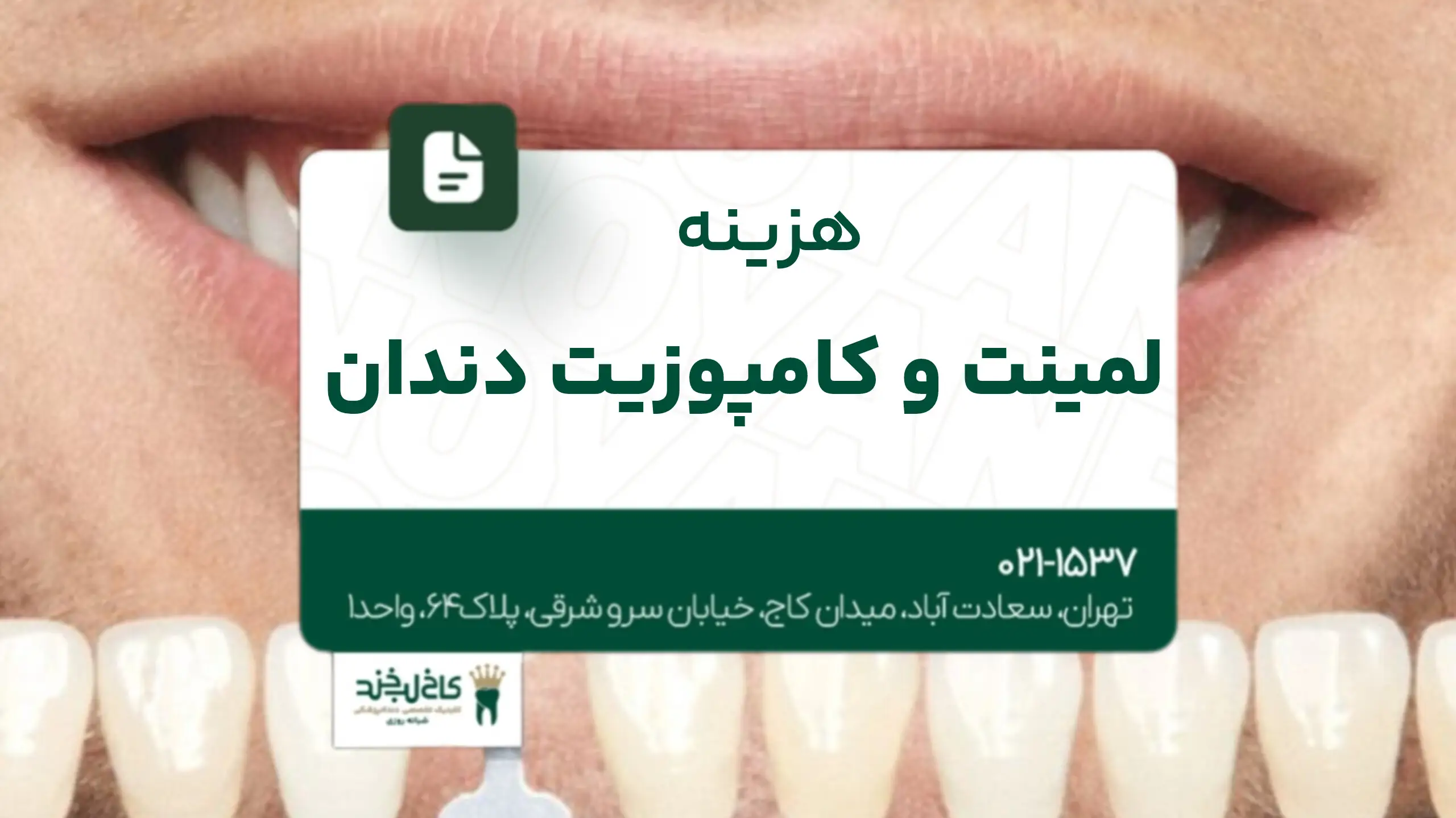 هزینه لمینت و کامپوزیت دندان