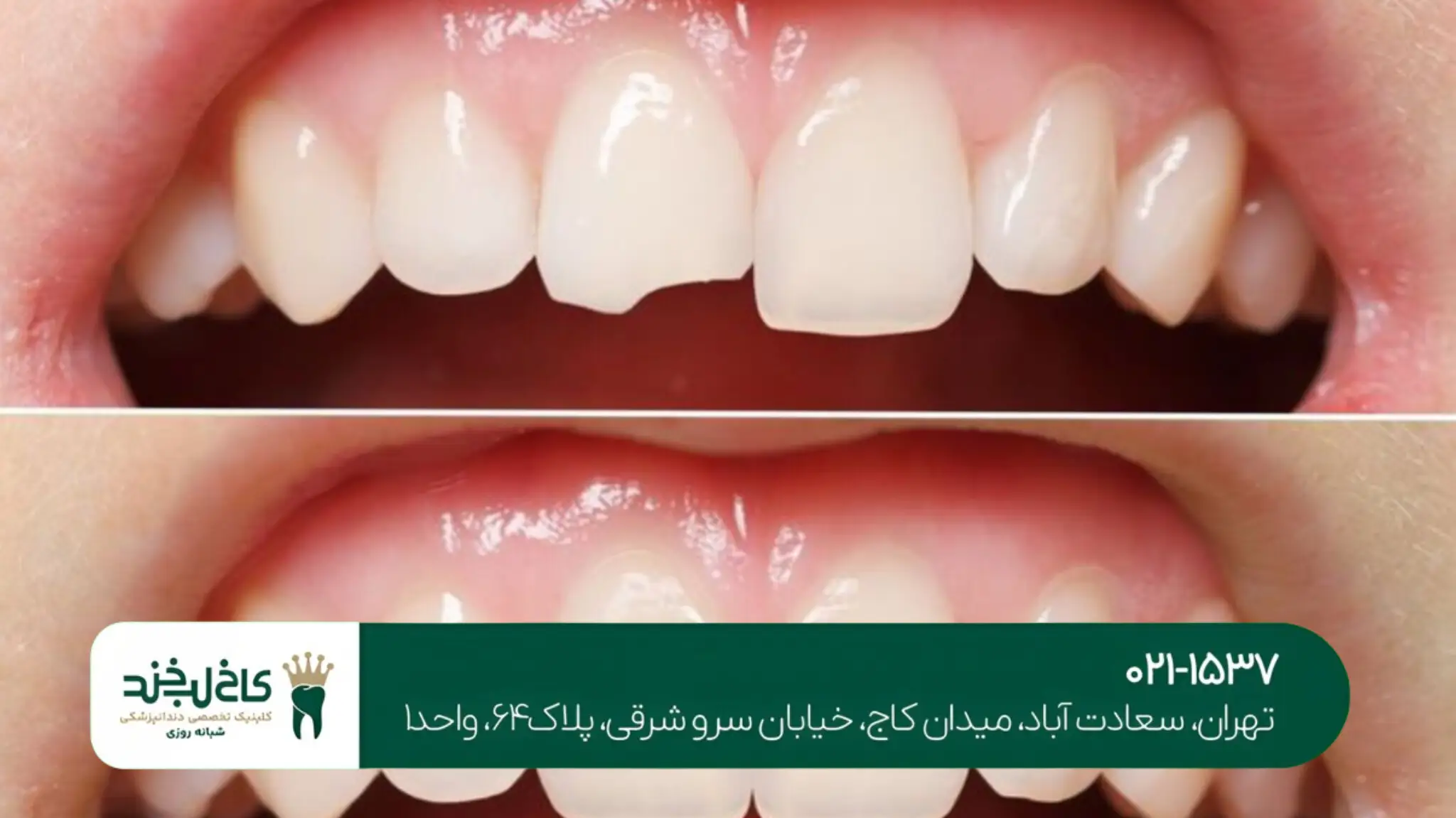 هزینه لمینت و کامپوزیت دندان