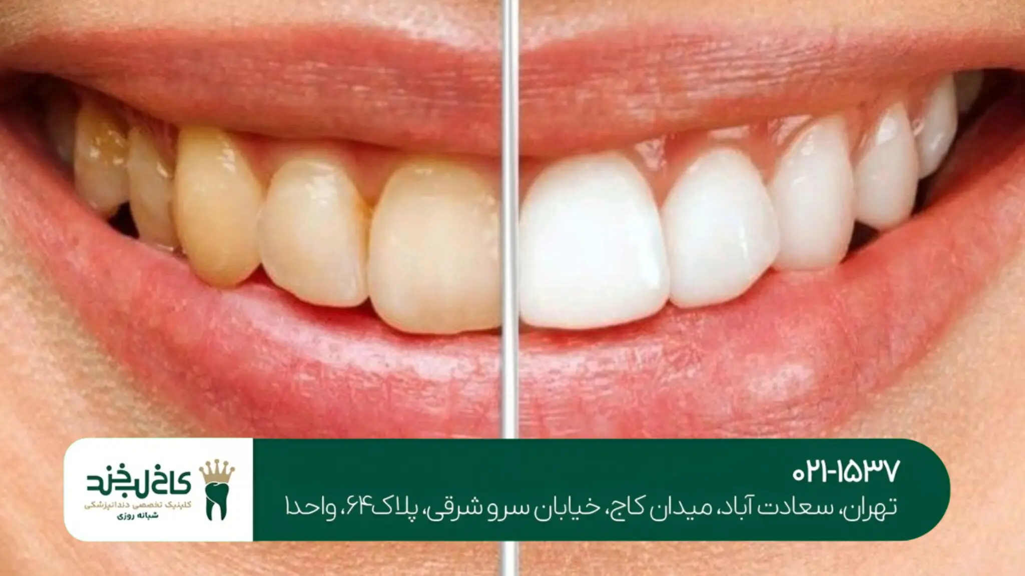 هزینه لمینت و کامپوزیت دندان