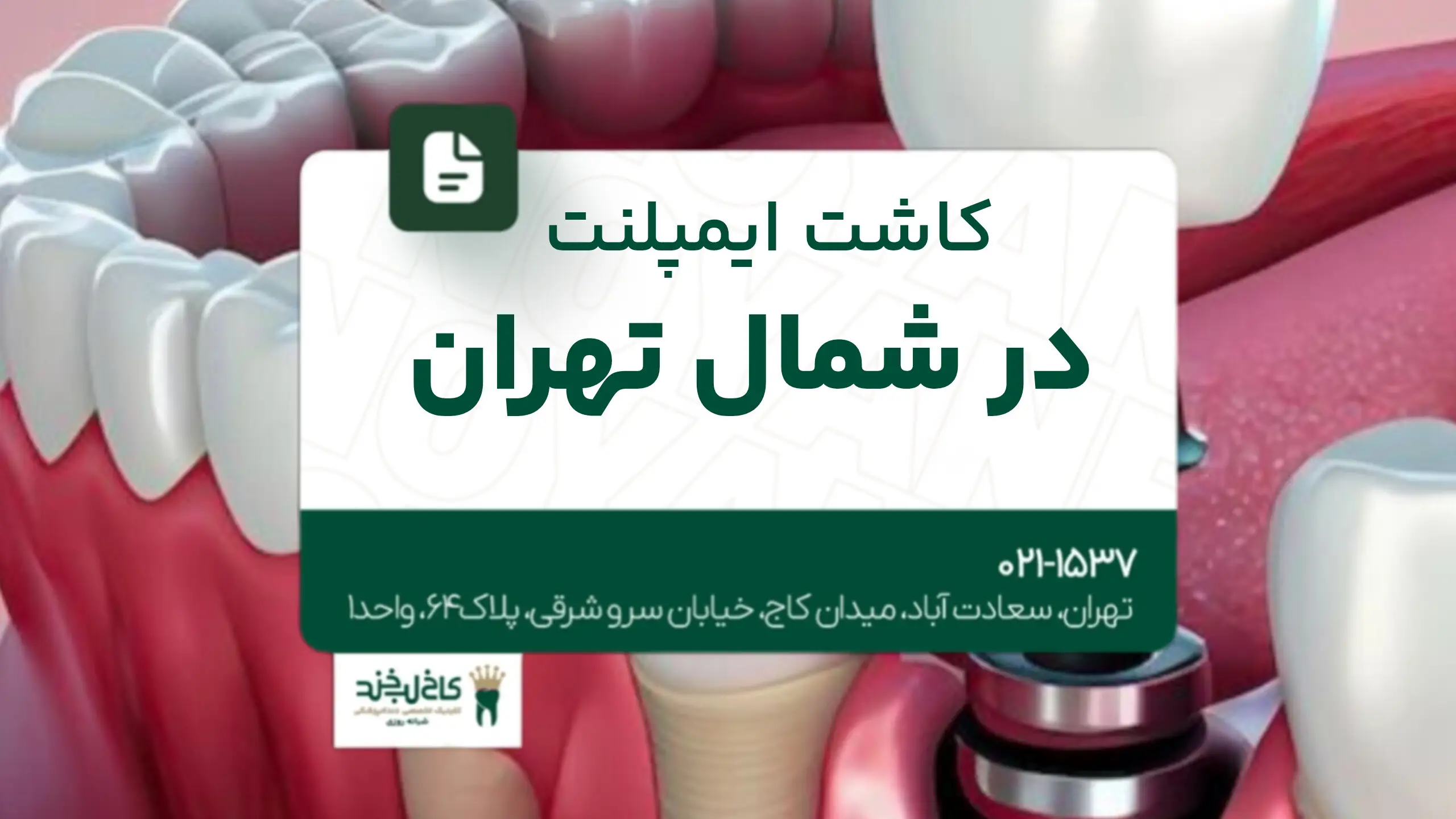 کاشت ایمپلنت در شمال تهران