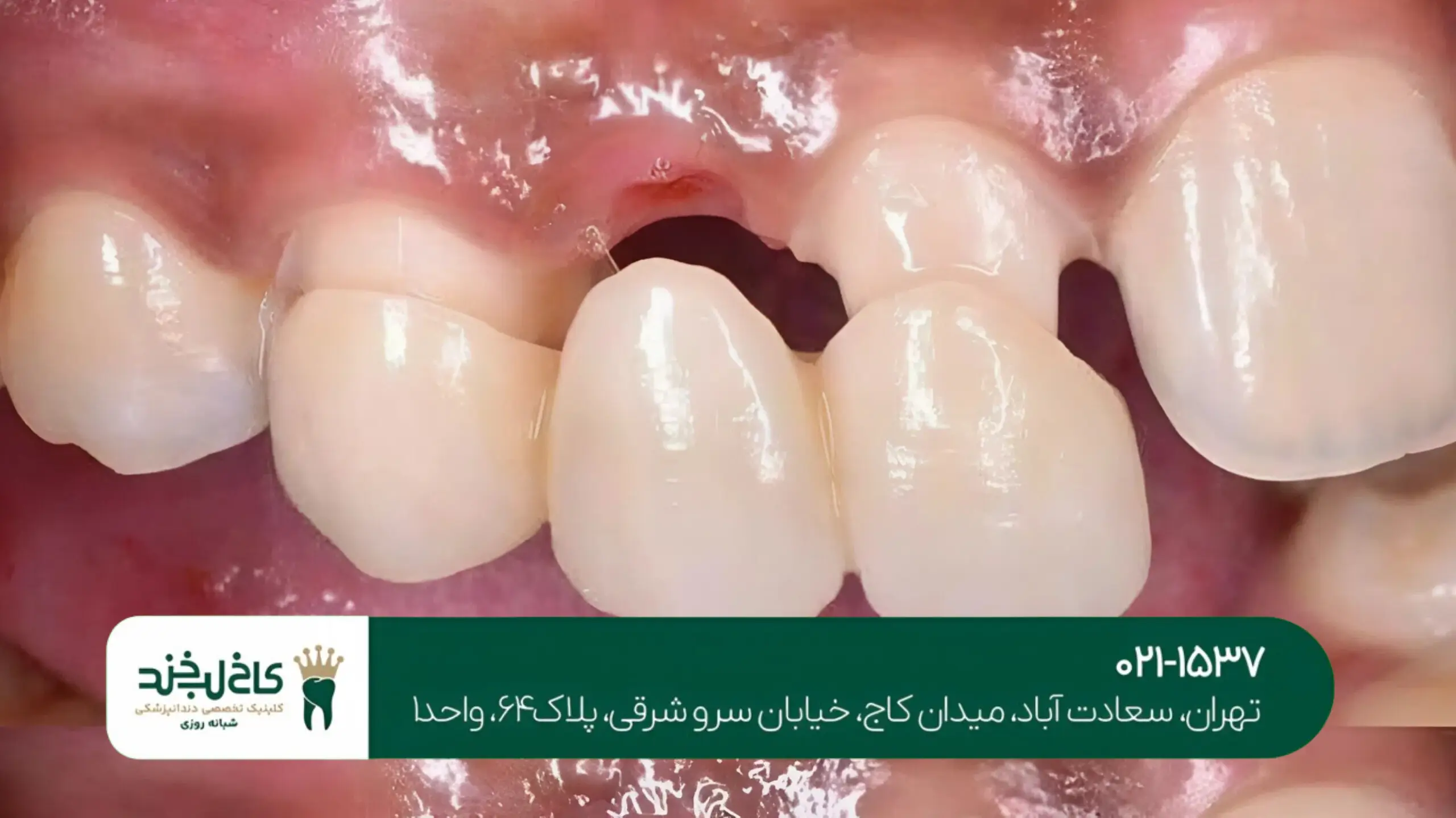 کاشت ایمپلنت در شمال تهران