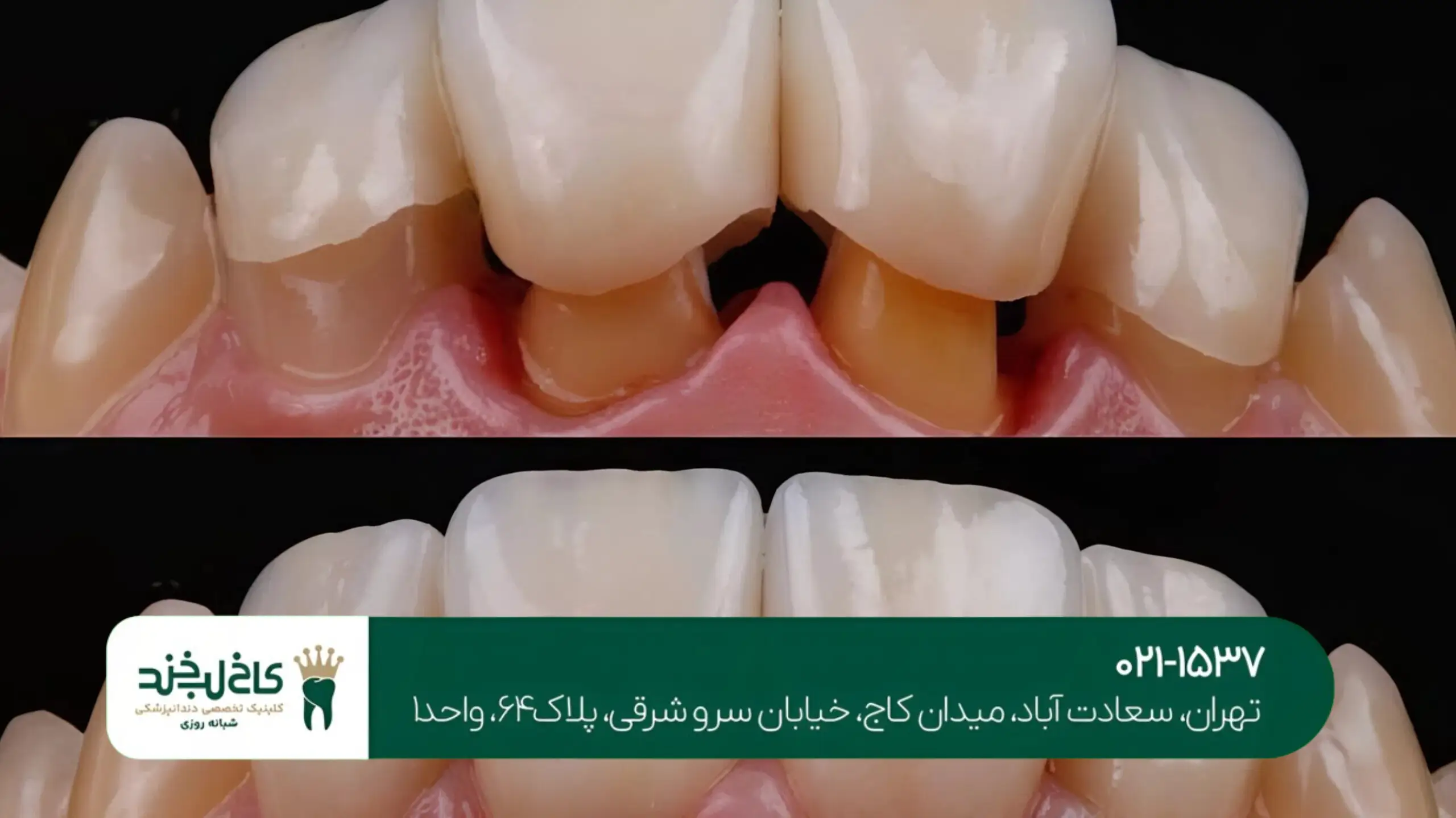 کاشت ایمپلنت در شمال تهران