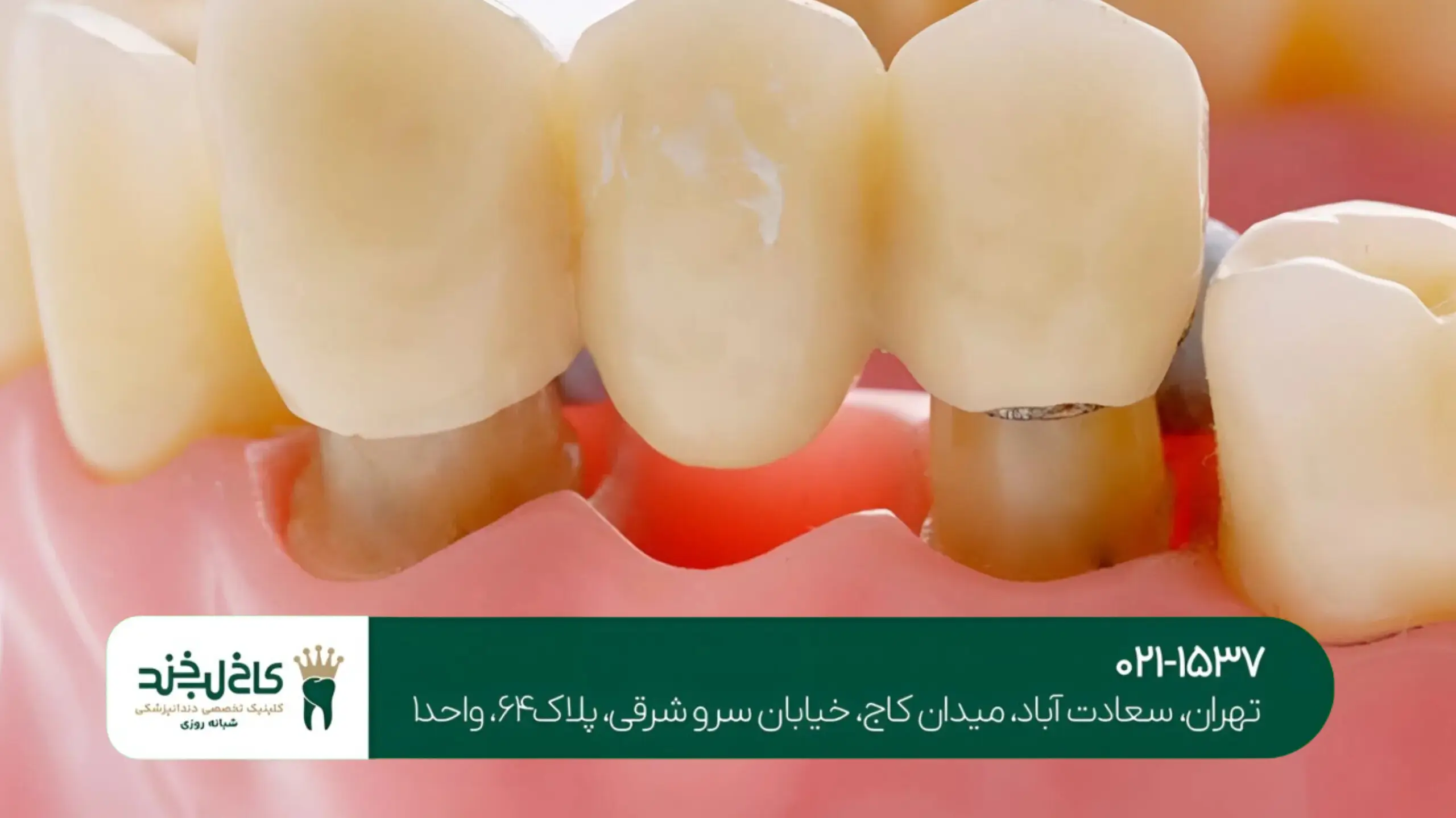 کاشت ایمپلنت در شمال تهران