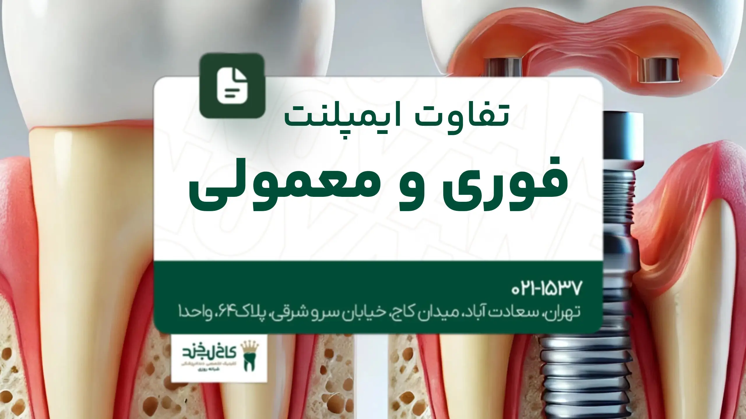 تفاوت ایمپلنت فوری و معمولی