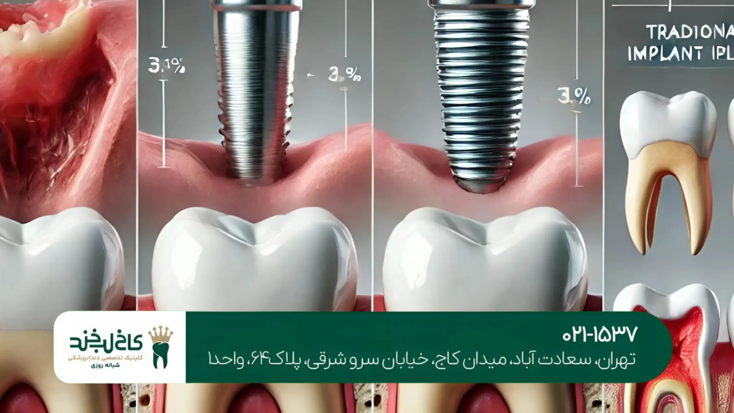 تفاوت ایمپلنت فوری و معمولی