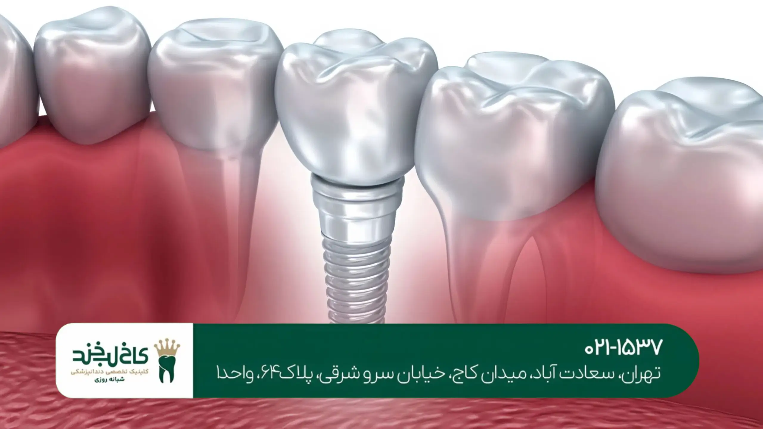 تفاوت ایمپلنت فوری و معمولی
