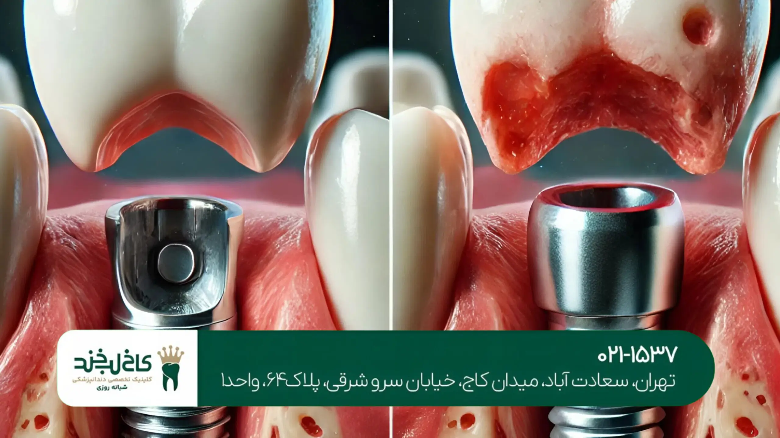 تفاوت ایمپلنت فوری و معمولی