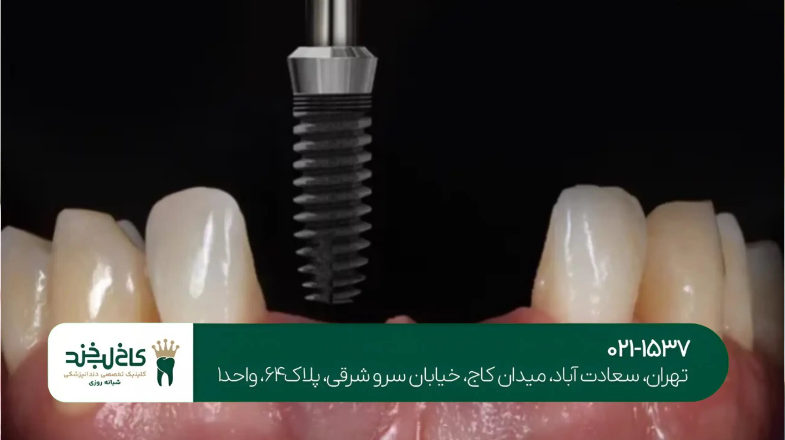 ایمپلنت دیجیتال با دستگاه سهبعدی