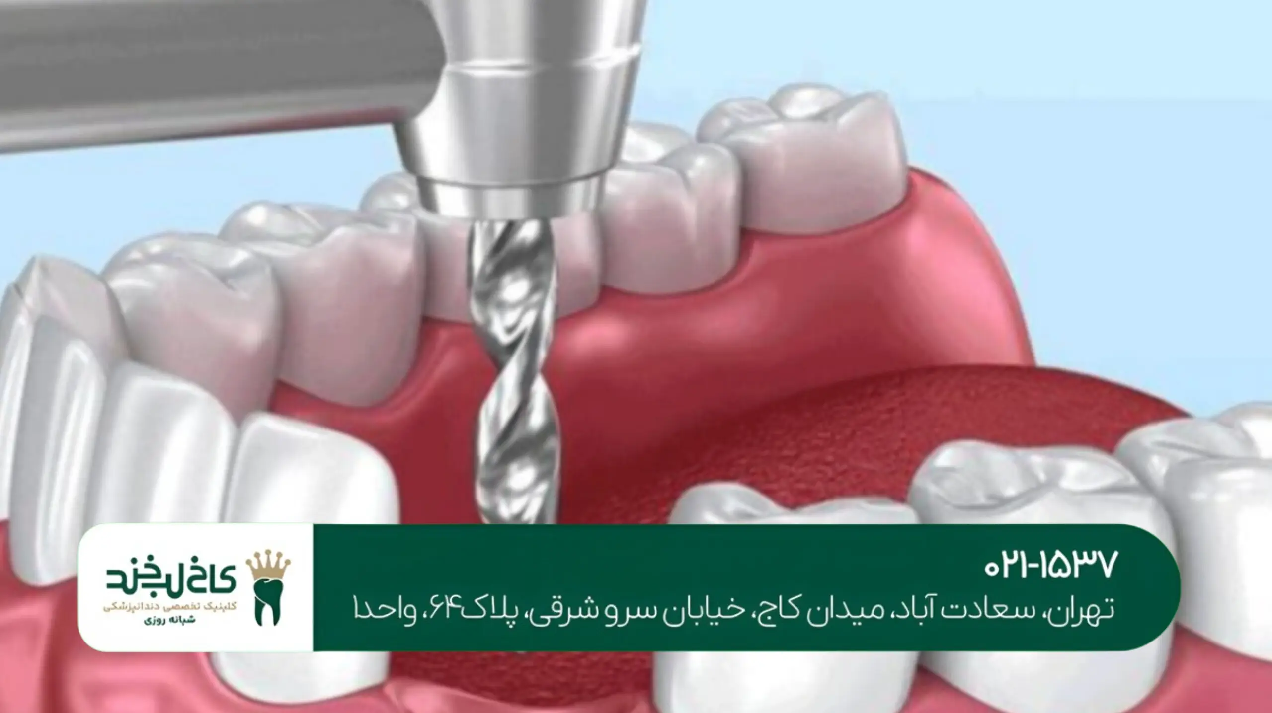 کاشت دندان با لیزر در تهران