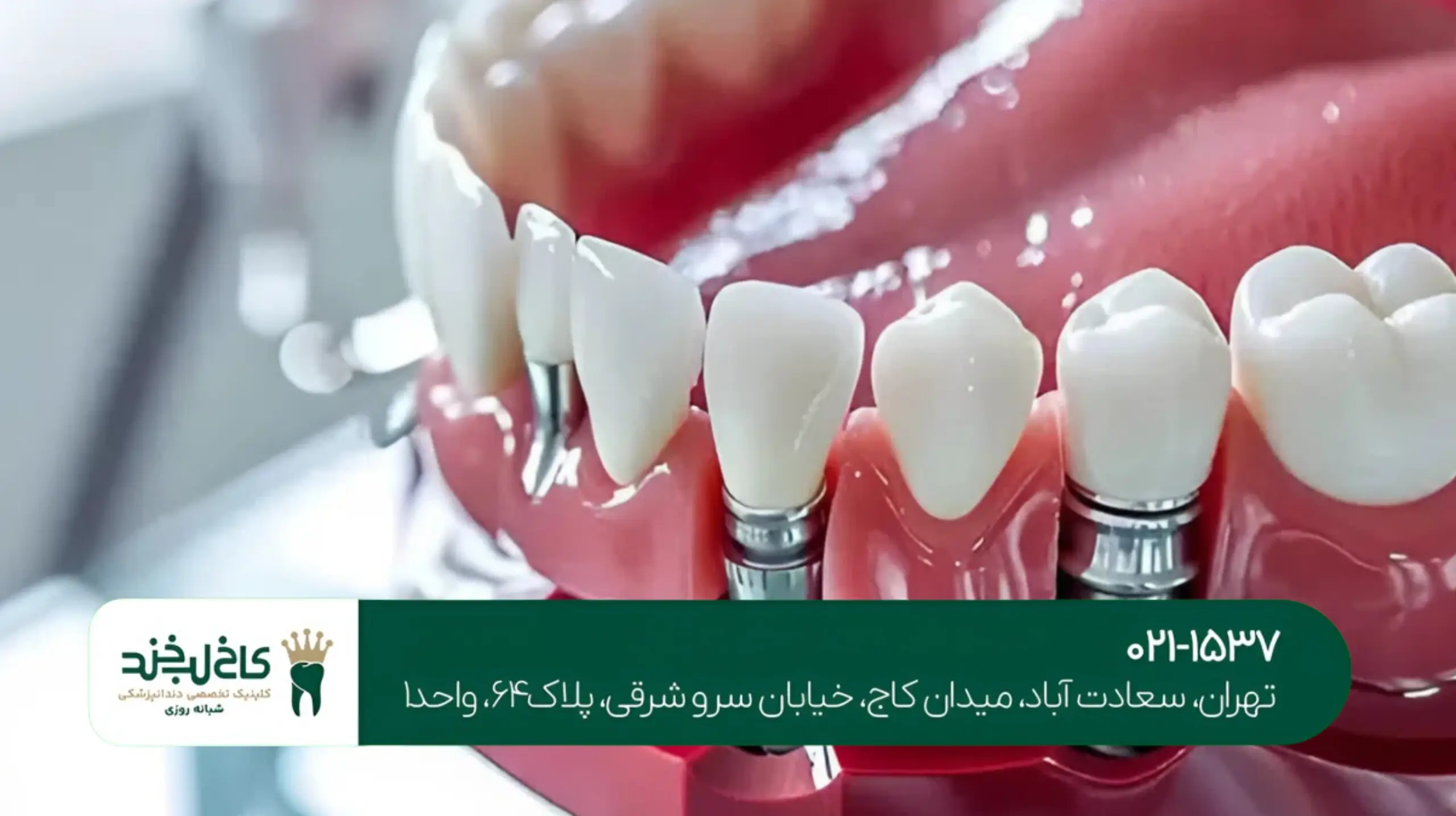 کاشت دندان با لیزر در تهران