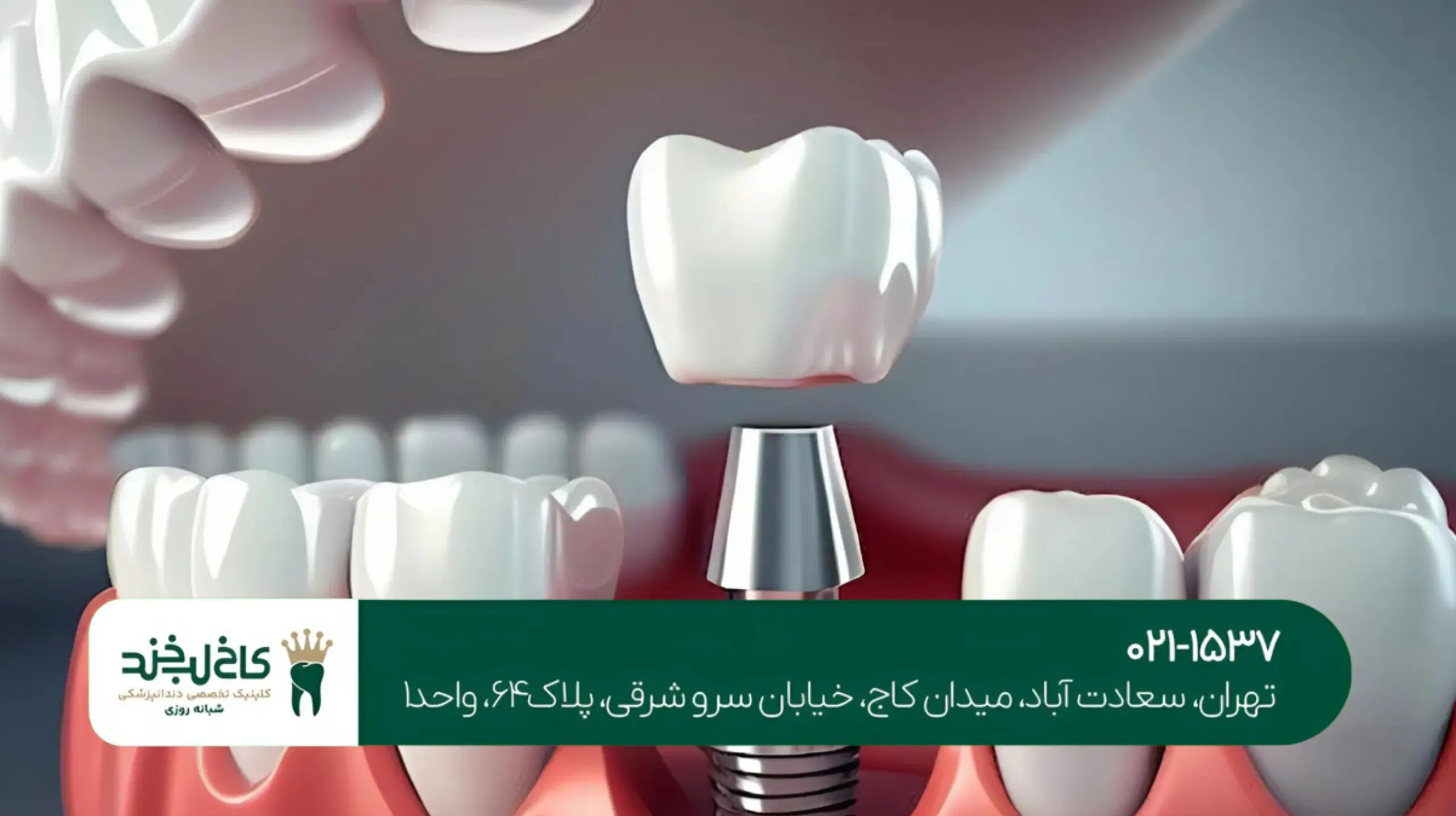 کاشت دندان با لیزر در تهران