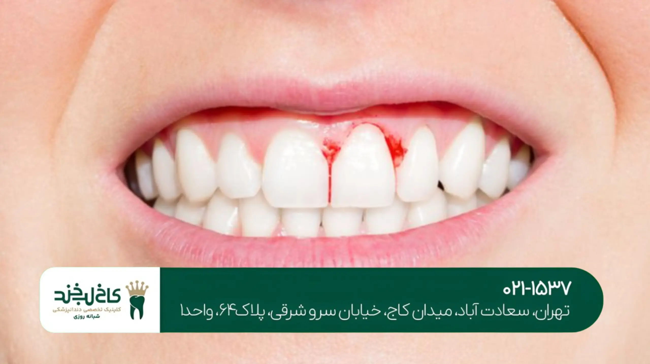 هزینه اصلاح طرح لبخند در تهران