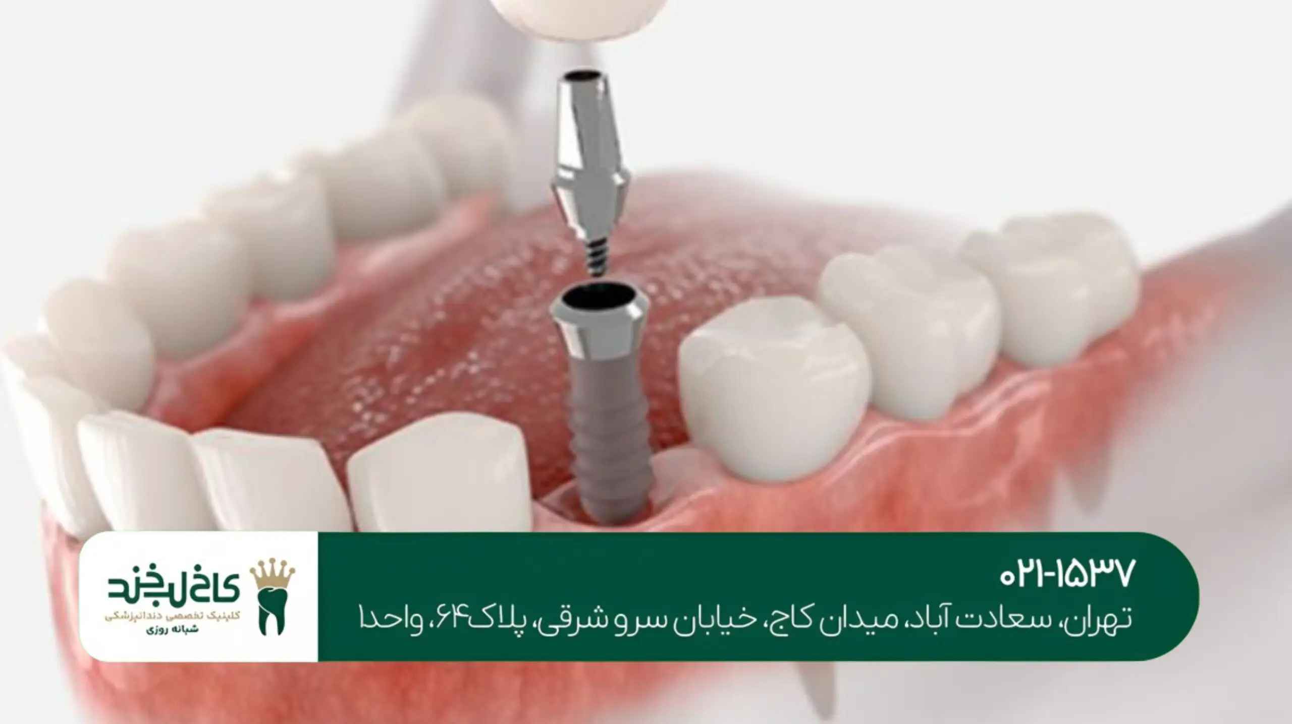 ایمپلنت فوری بعد از کشیدن دندان