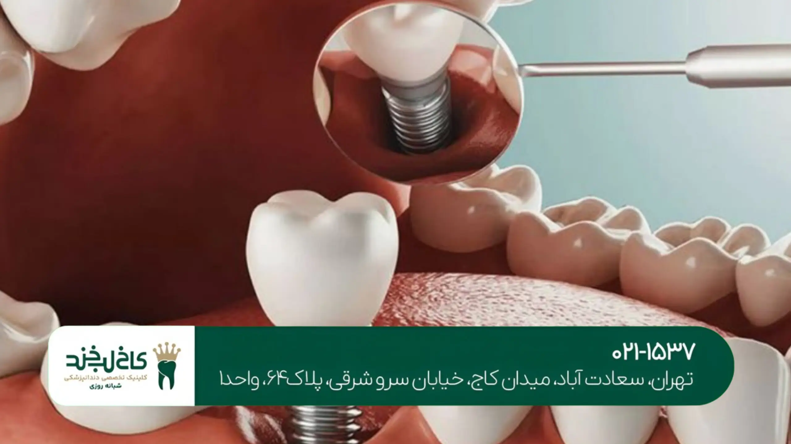 ایمپلنت فوری بعد از کشیدن دندان