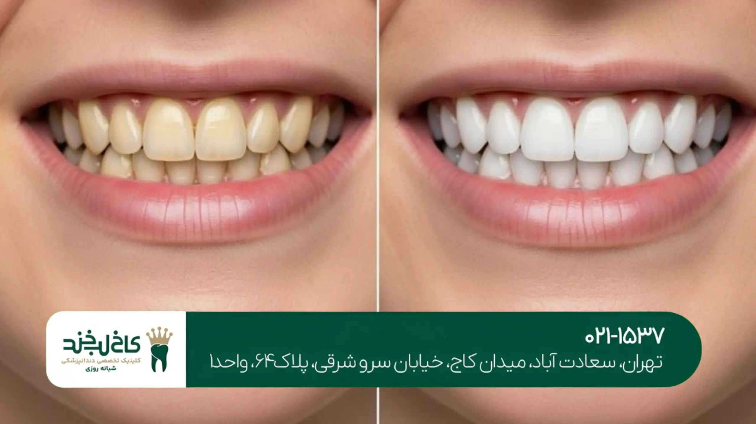 هزینه اصلاح طرح لبخند در تهران