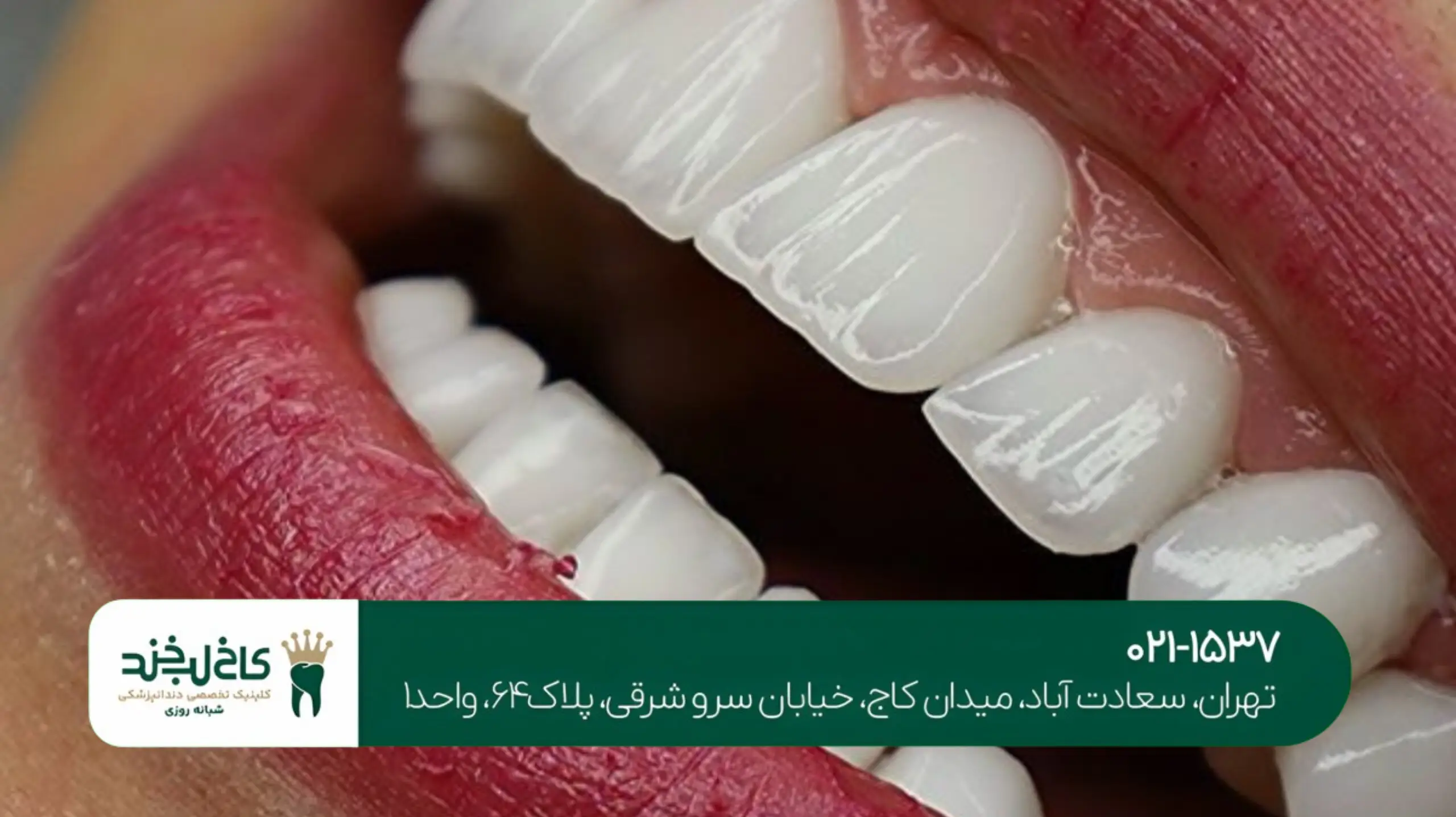 ایمپلنت دندان جلو برای لبخند زیباتر