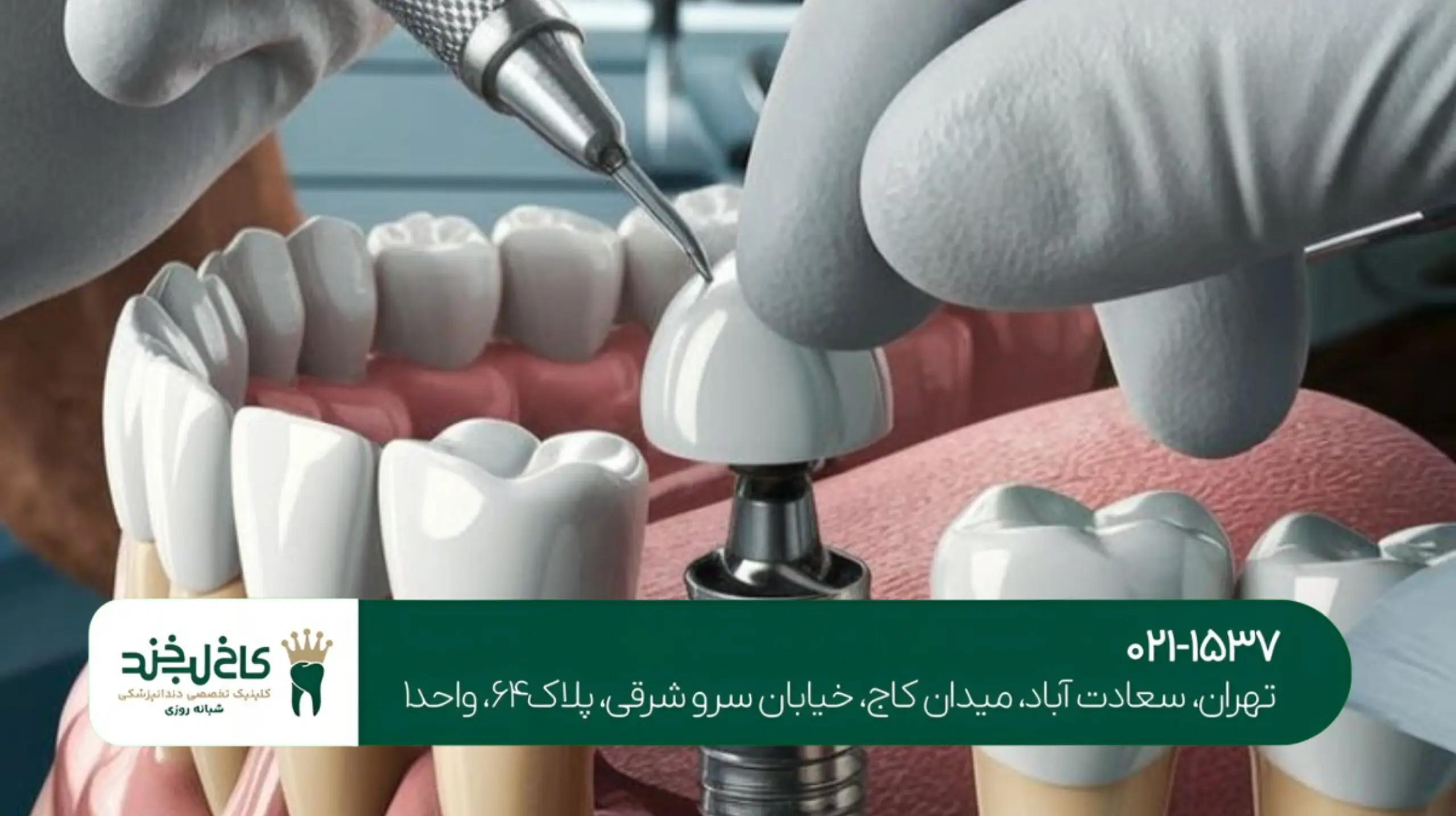 چه کسانی نمیتوانند ایمپلنت انجام دهند؟