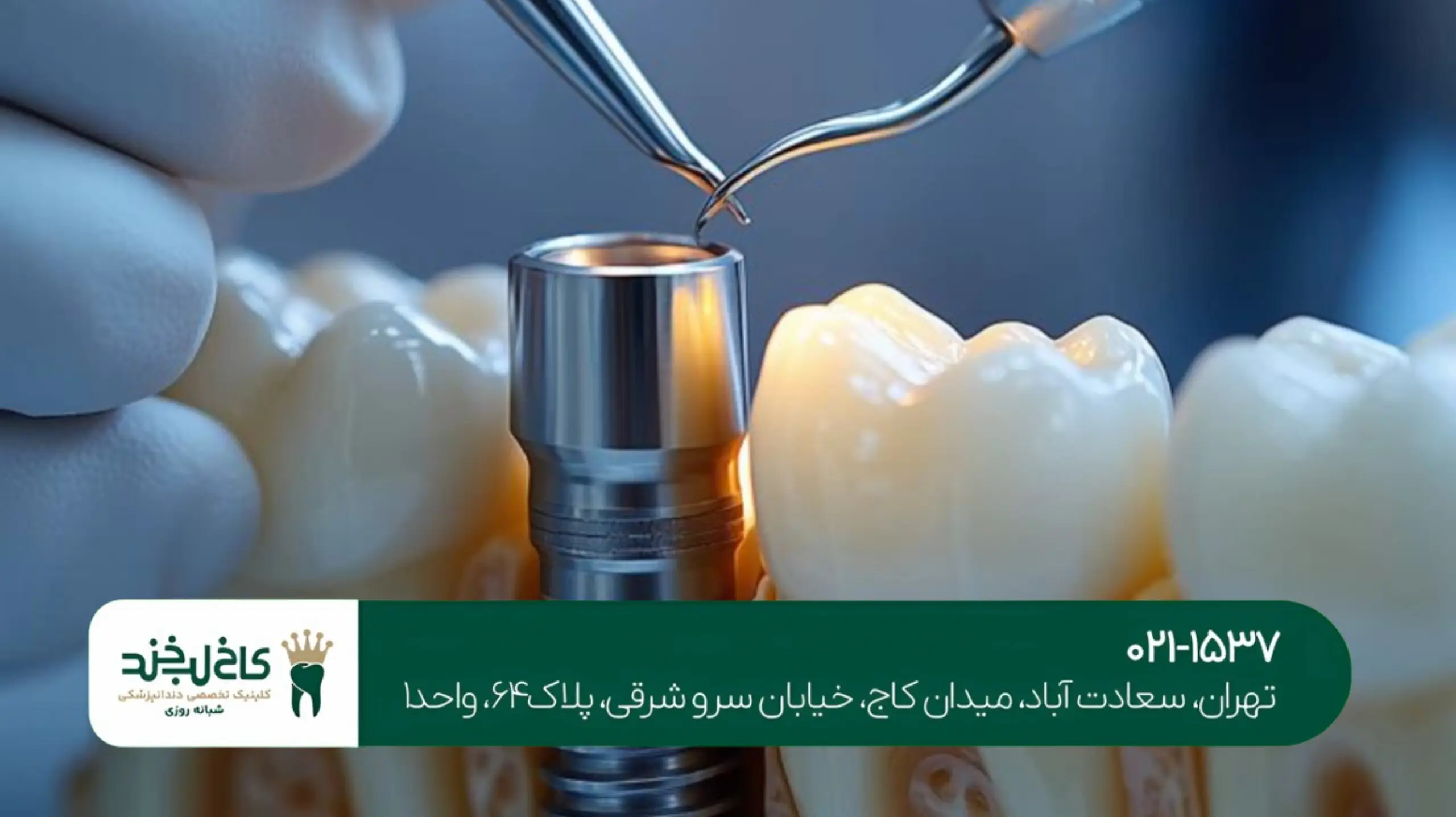 مزایای ایمپلنت نسبت به دندان مصنوعی