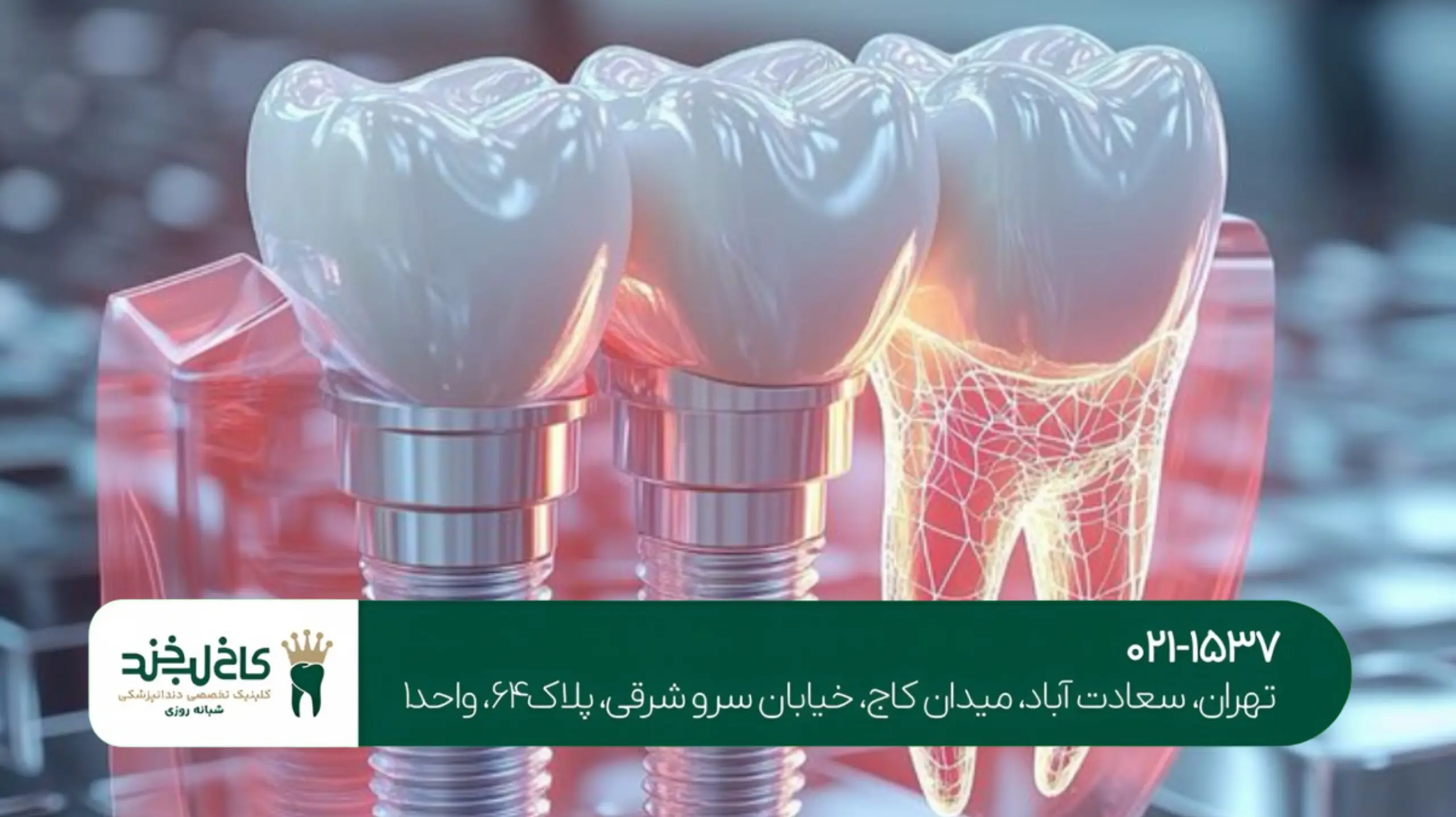 مزایای ایمپلنت نسبت به دندان مصنوعی