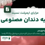 مزایای ایمپلنت نسبت به دندان مصنوعی