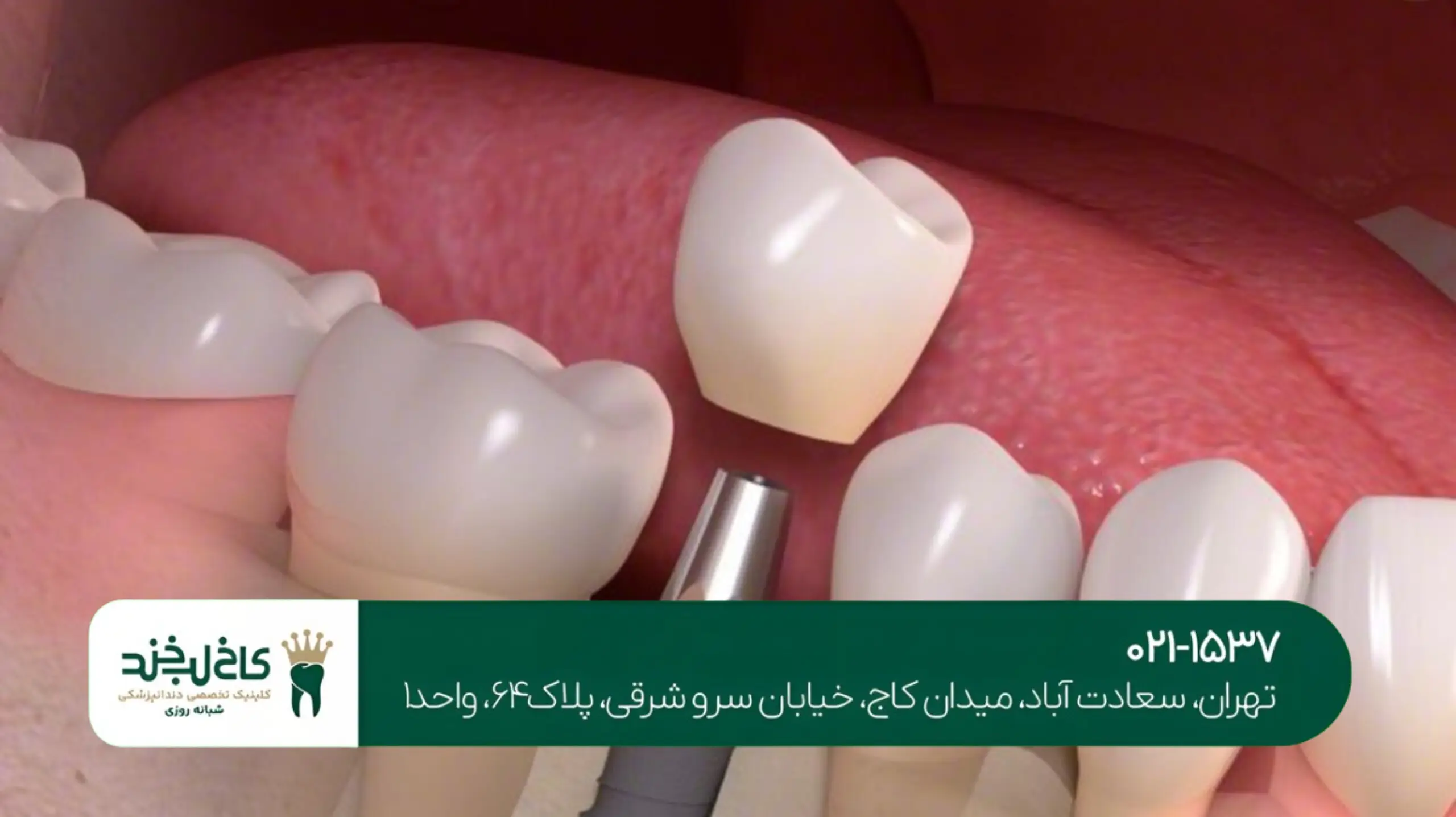 دندانپزشکی با بیحسی موضعی بدون درد