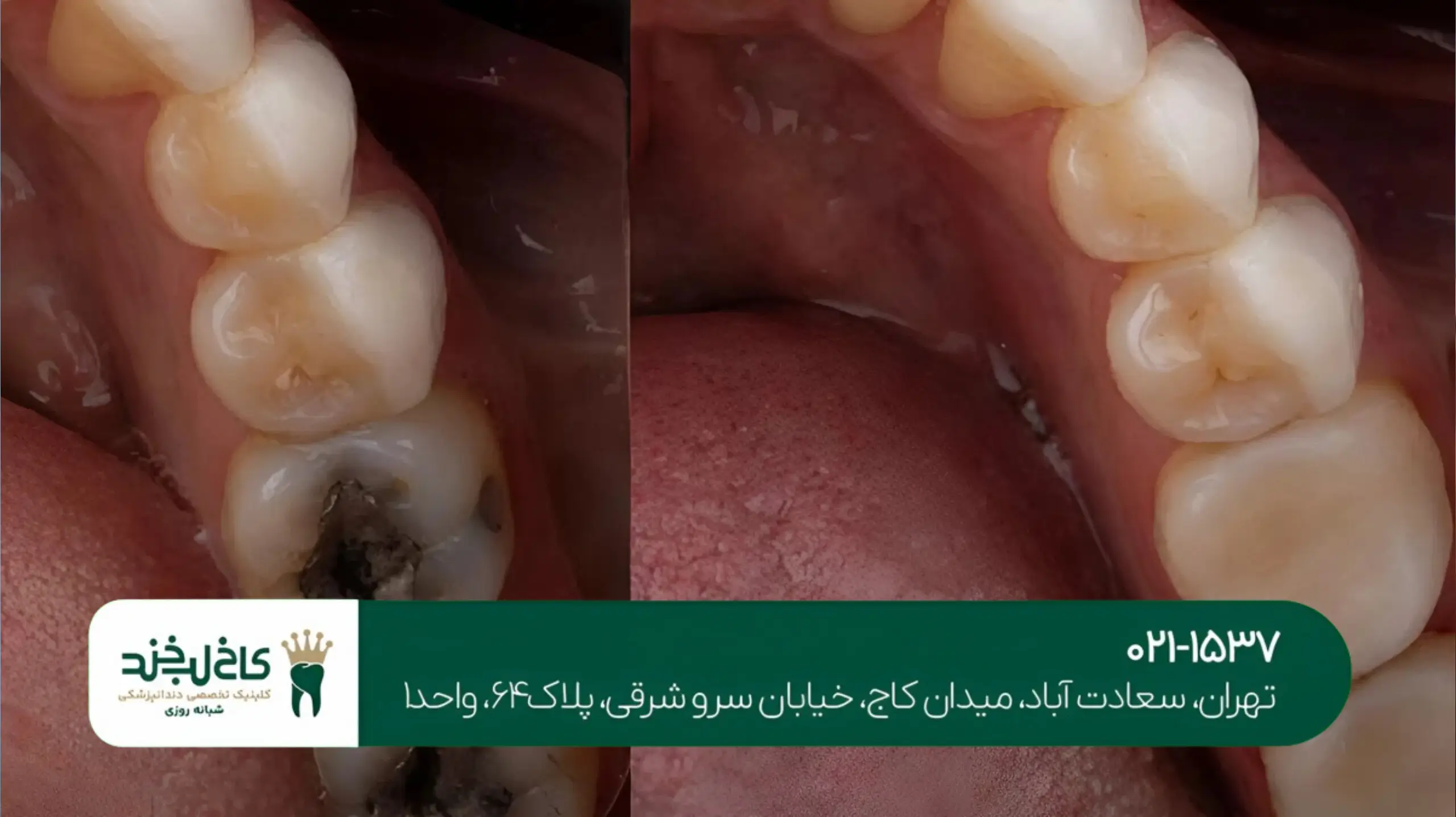 ترمیم دندان پوسیده با مواد سفید