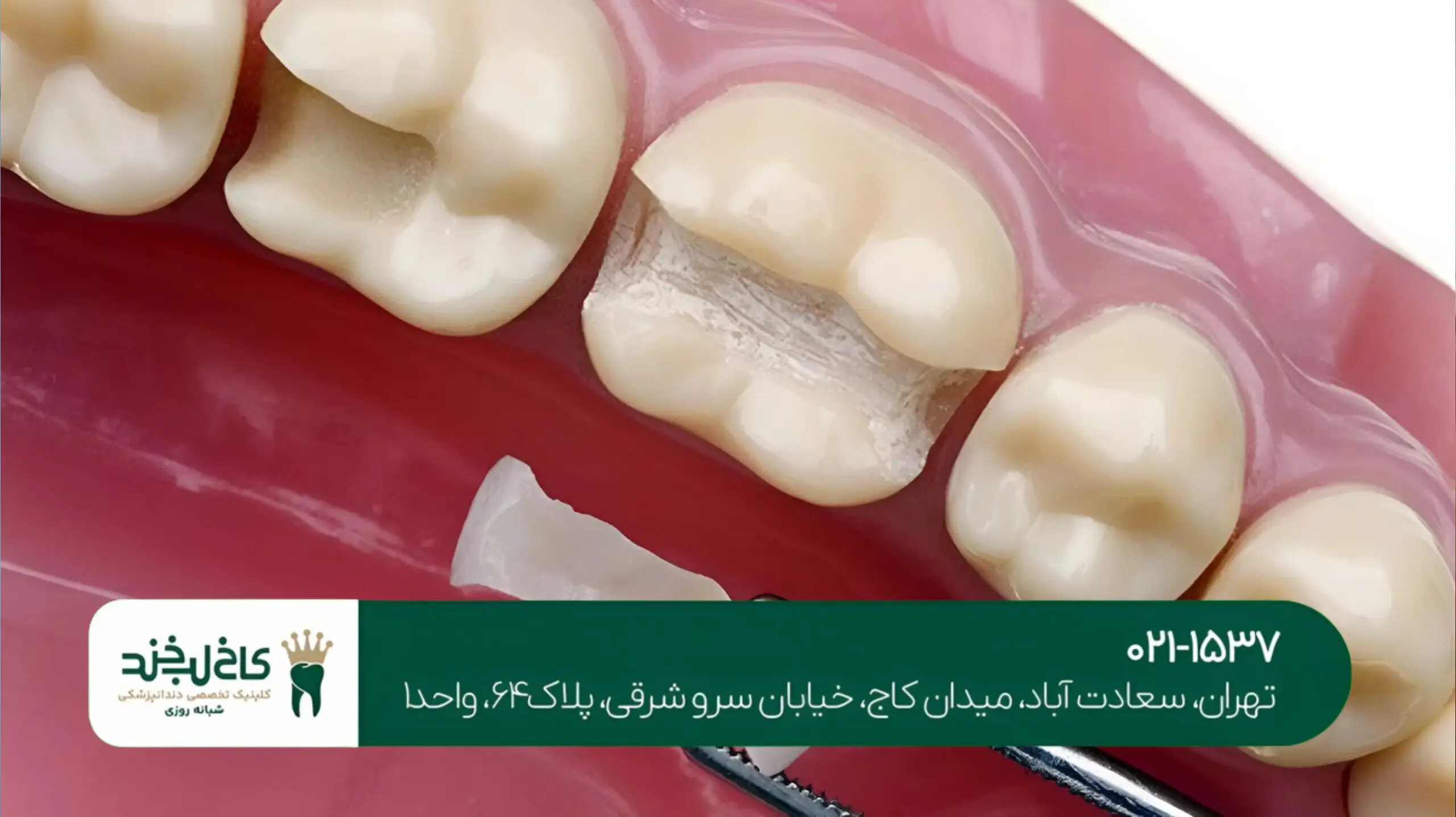 ترمیم دندان پوسیده با مواد سفید