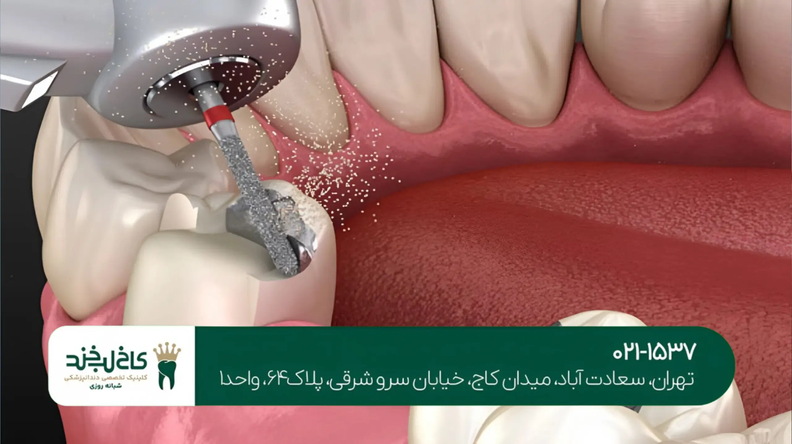 ترمیم دندان پوسیده با مواد سفید