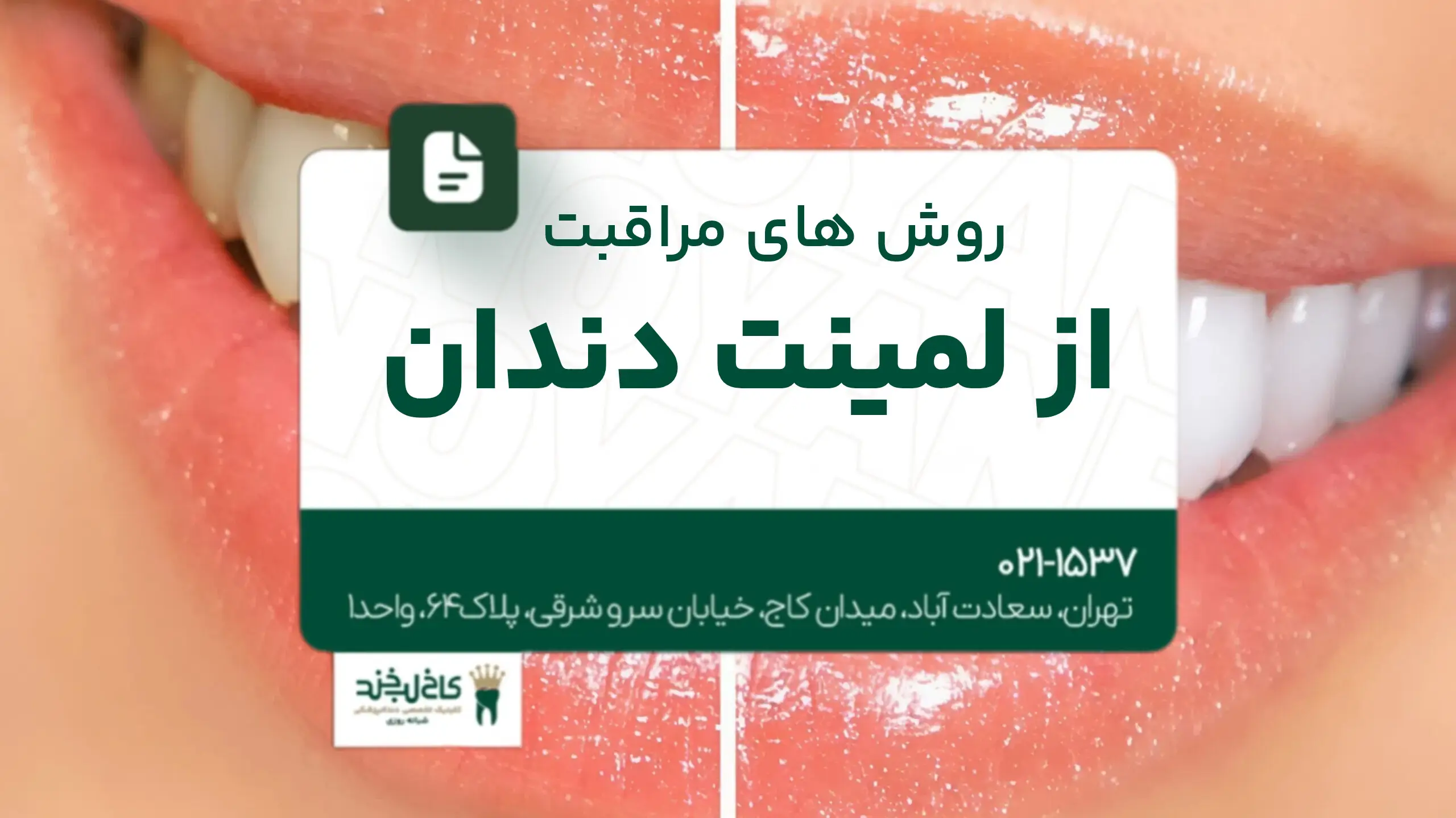 روشهای مراقبت از لمینت دندان