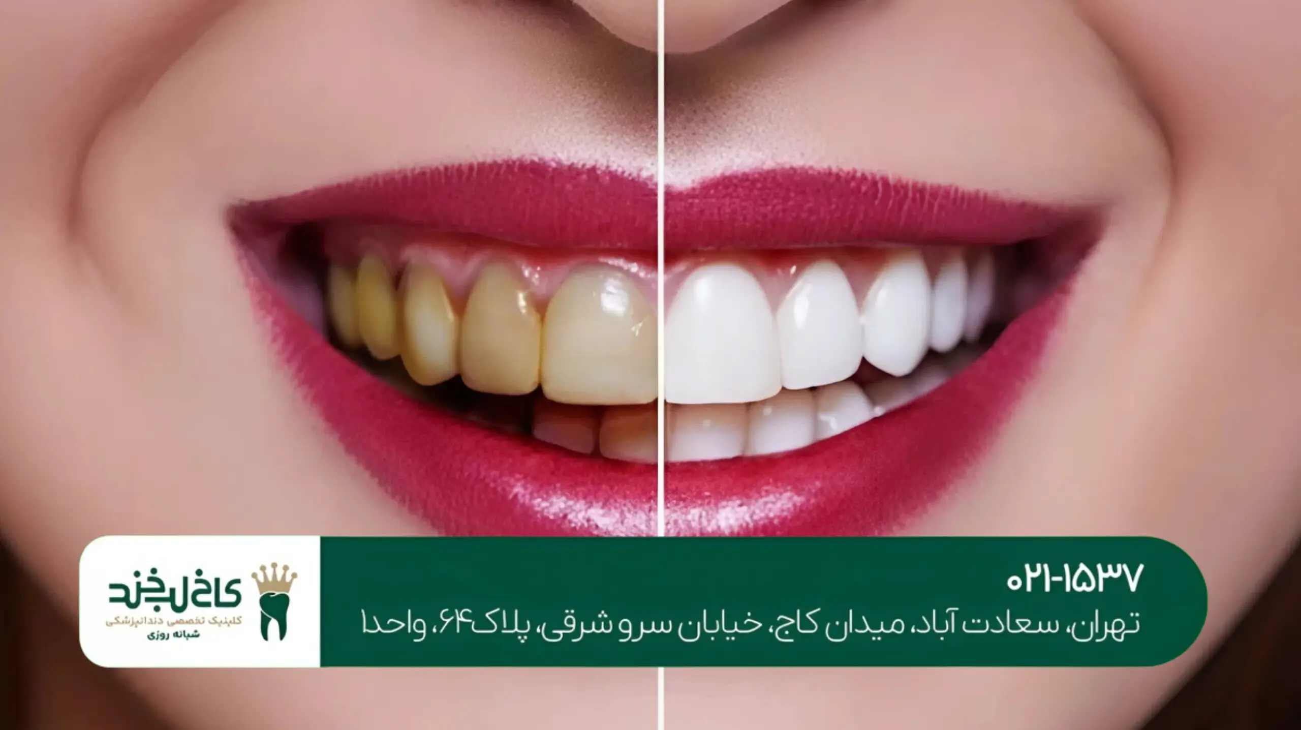 روشهای مراقبت از لمینت دندان