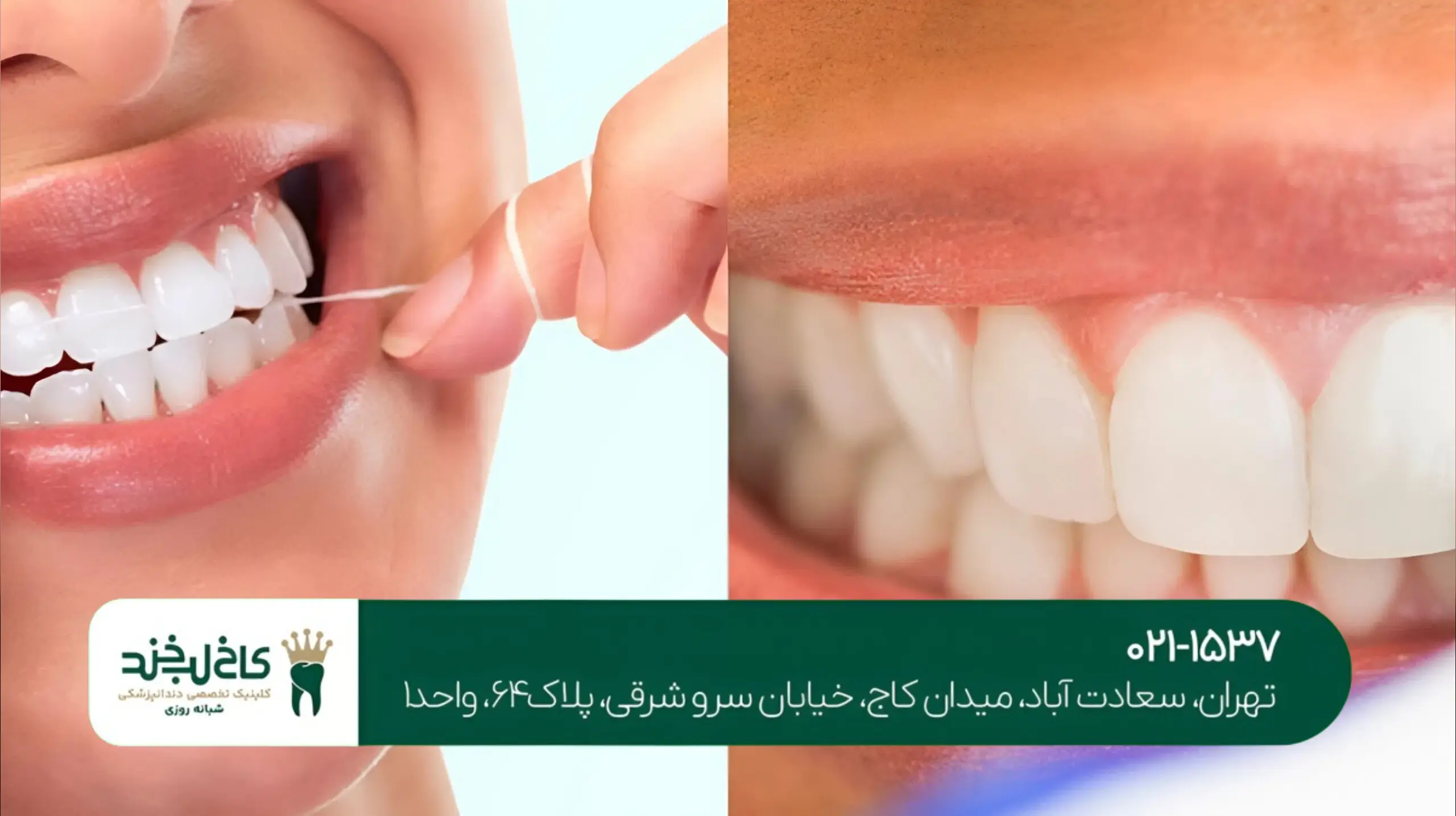 روشهای مراقبت از لمینت دندان