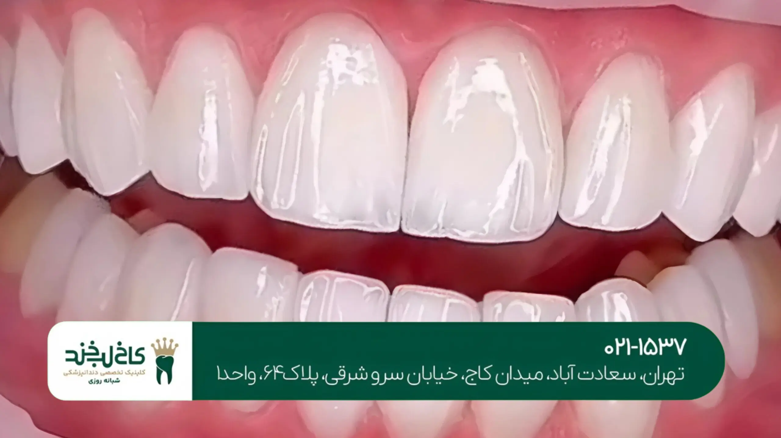 روشهای مراقبت از لمینت دندان