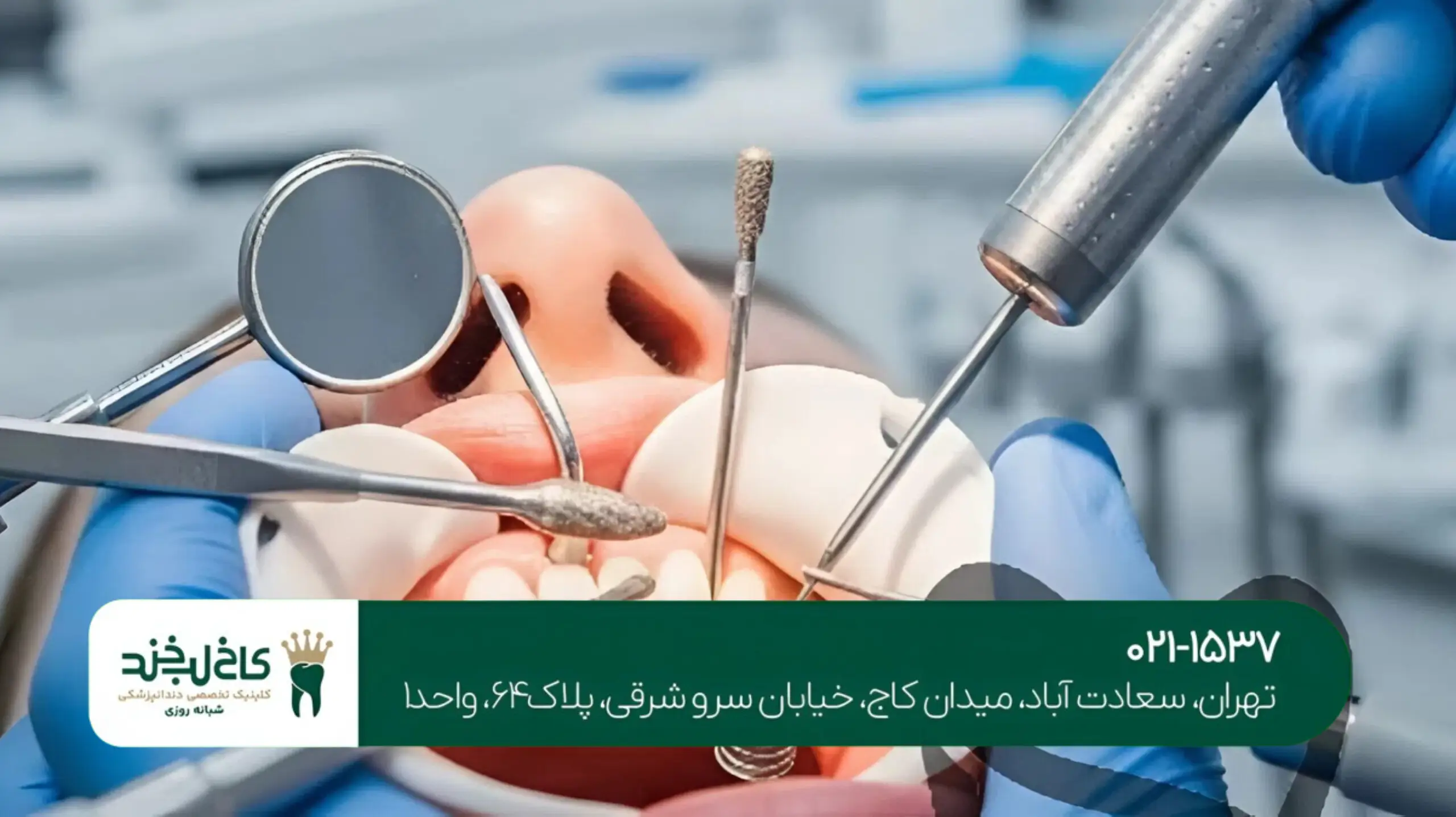 مشاوره رایگان ایمپلنت در تهران