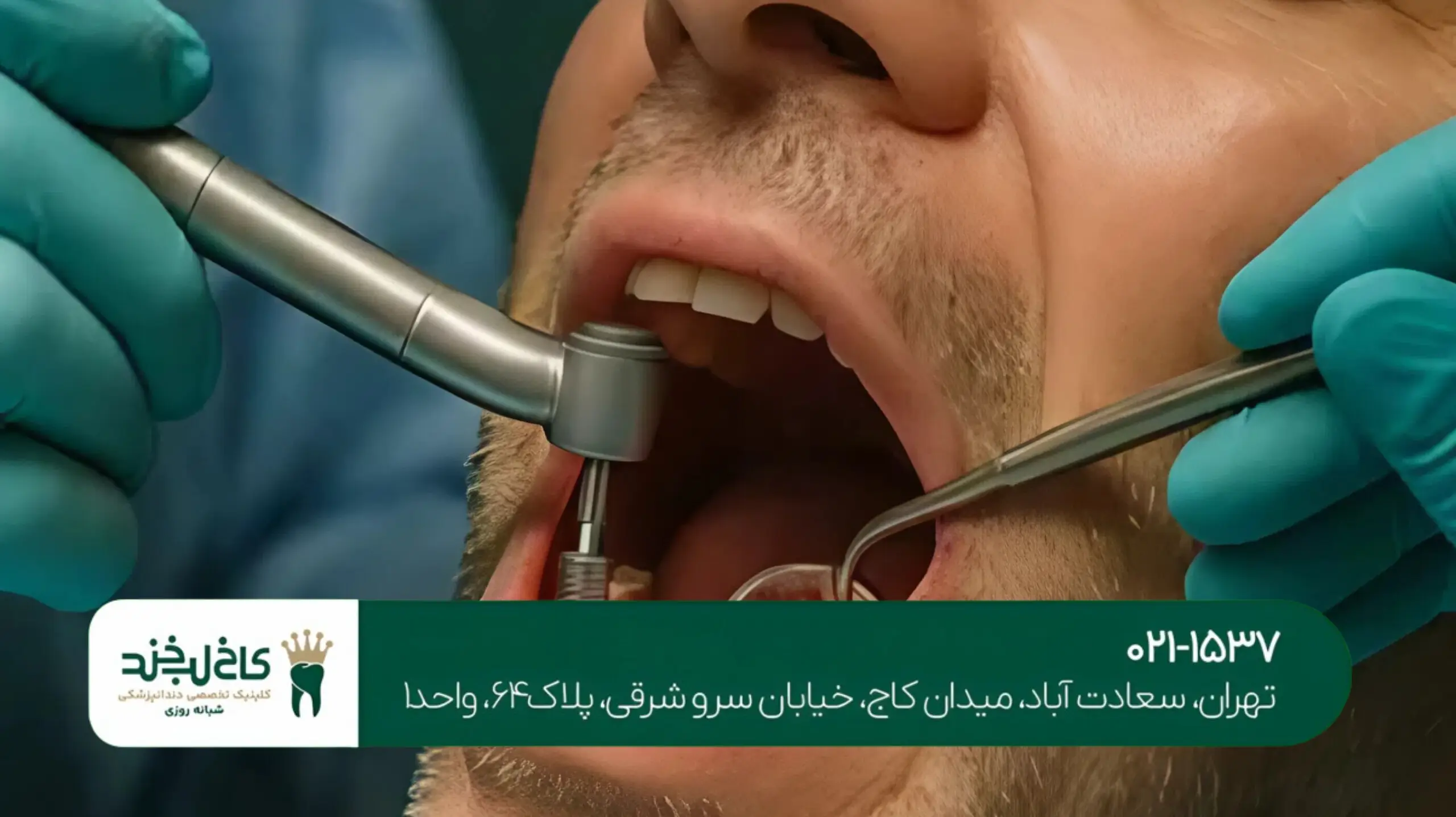 مشاوره رایگان ایمپلنت در تهران