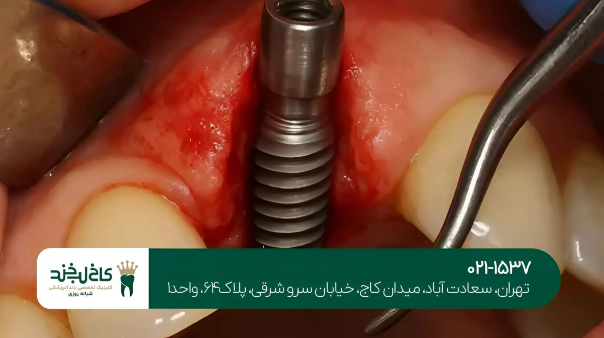 ایمپلنت دیجیتال سه‌بعدی در شمال تهران