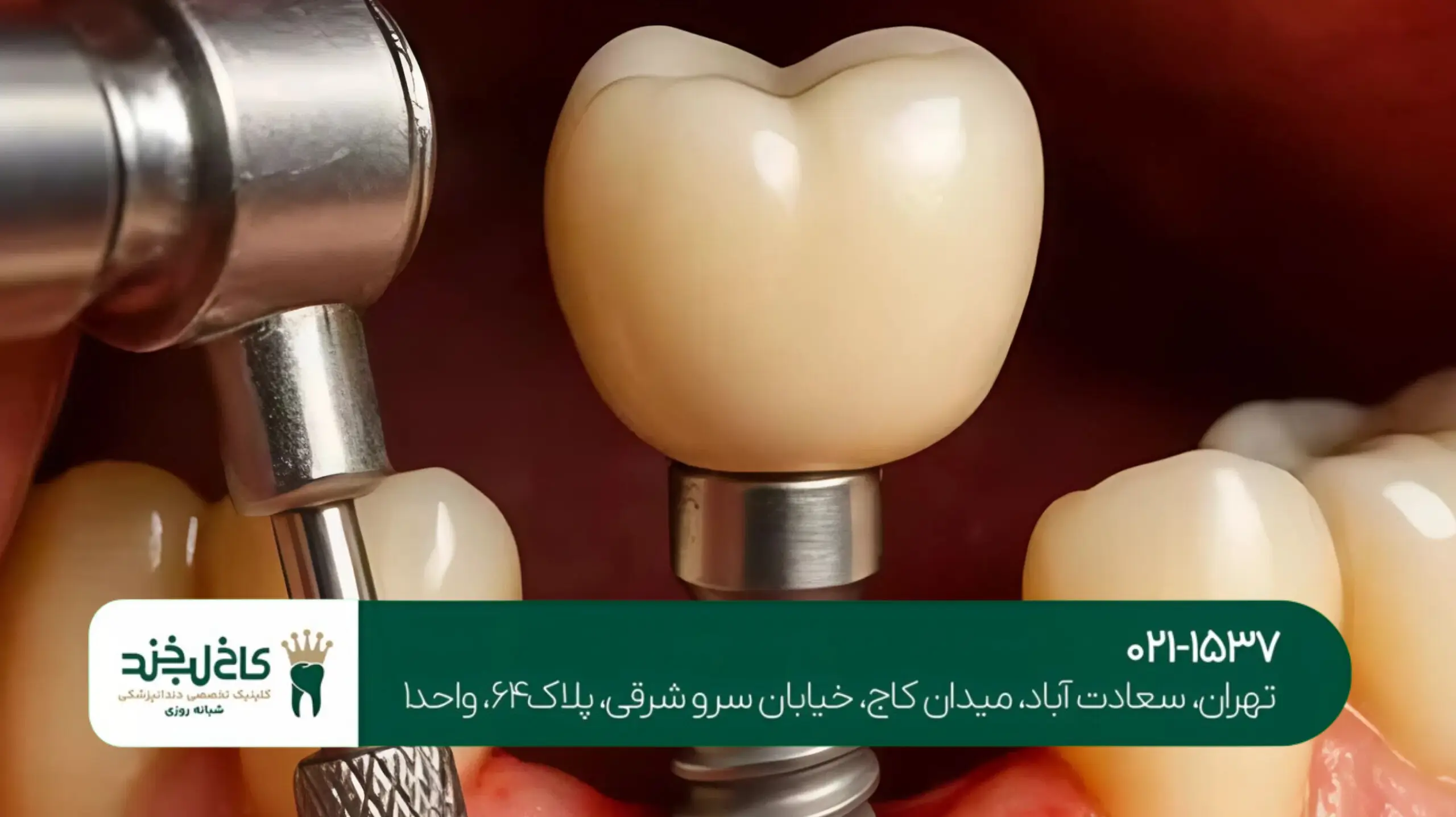 ایمپلنت دیجیتال سه‌بعدی در شمال تهران