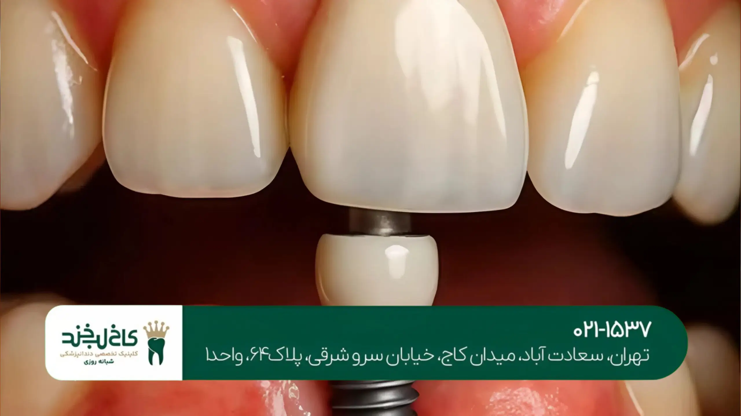 ایمپلنت دیجیتال سه‌بعدی در شمال تهران