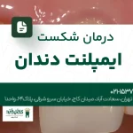 درمان شکست ایمپلنت دندان