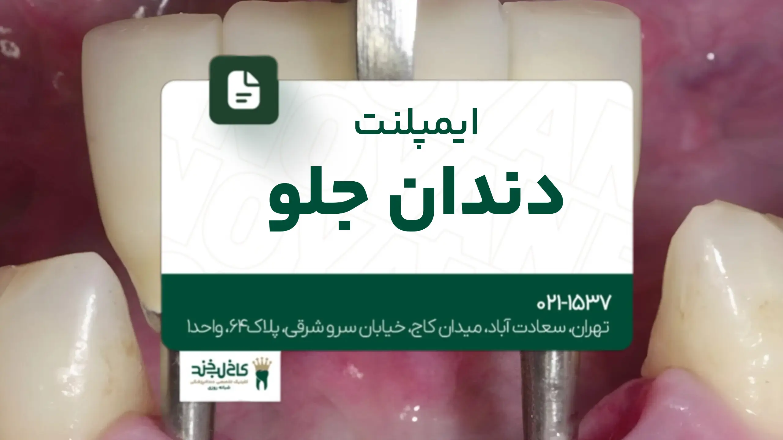 ایمپلنت دندان جلو