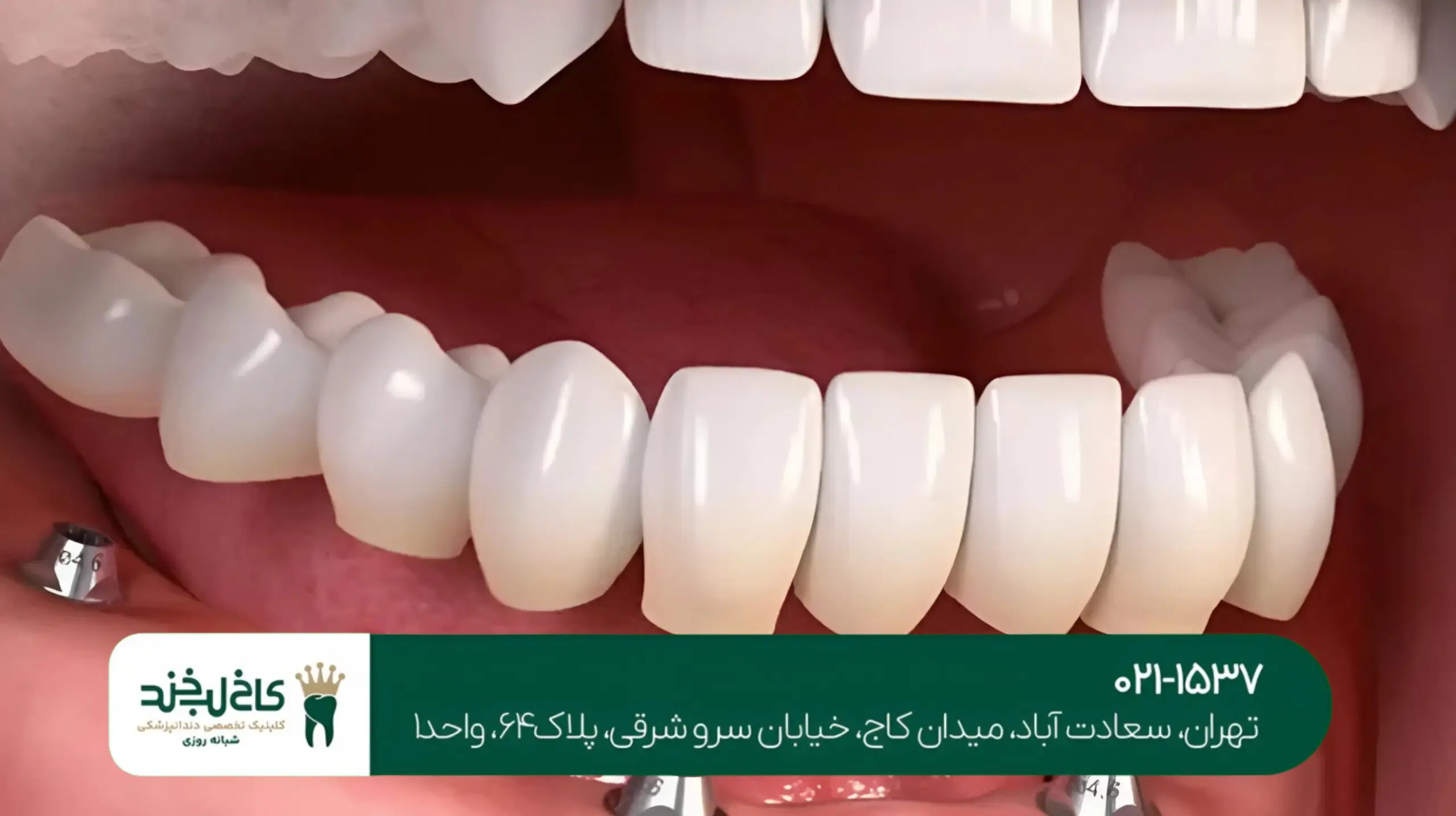 ایمپلنت دندان جلو