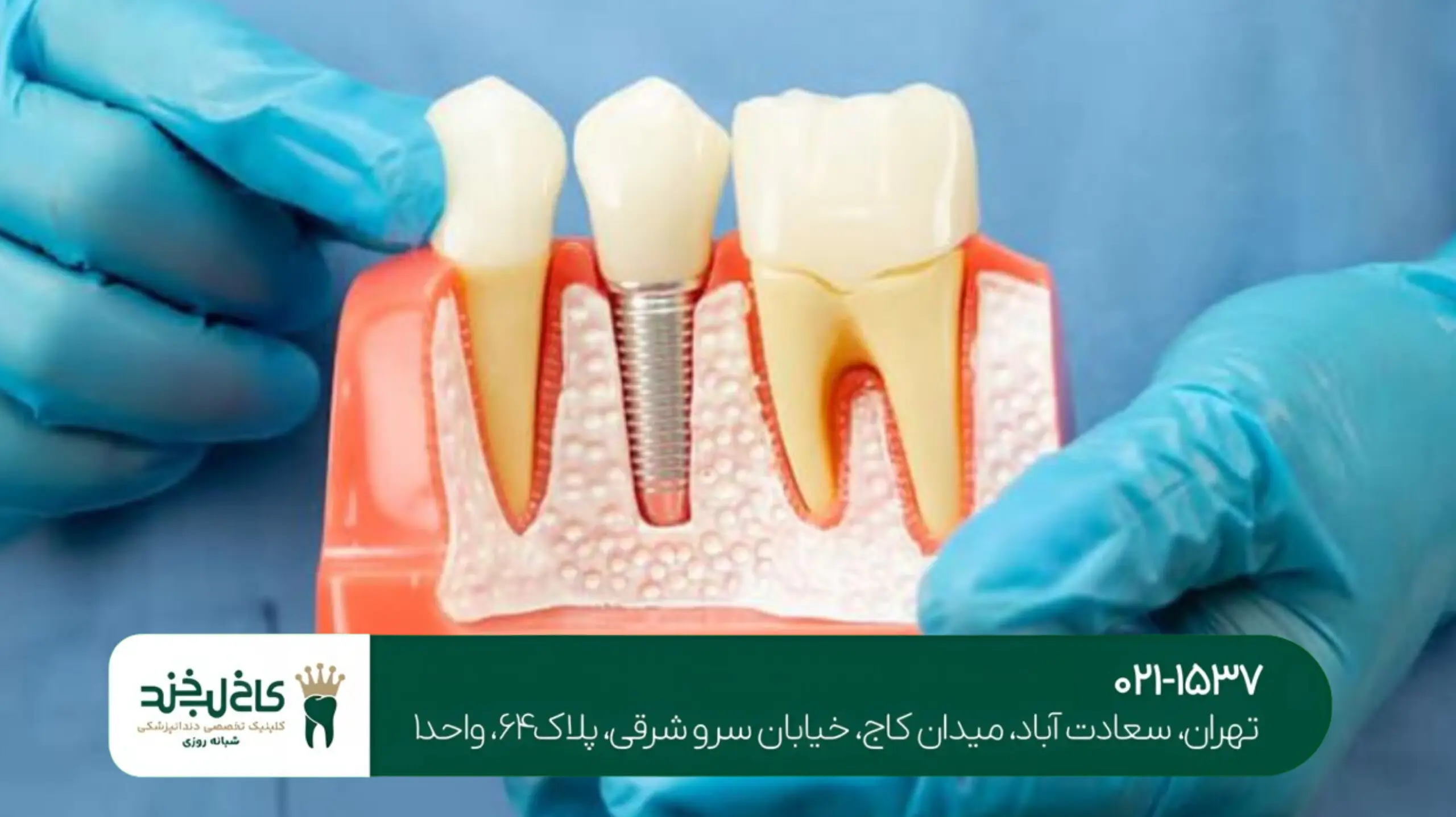 کاشت دندان بدون بخیه