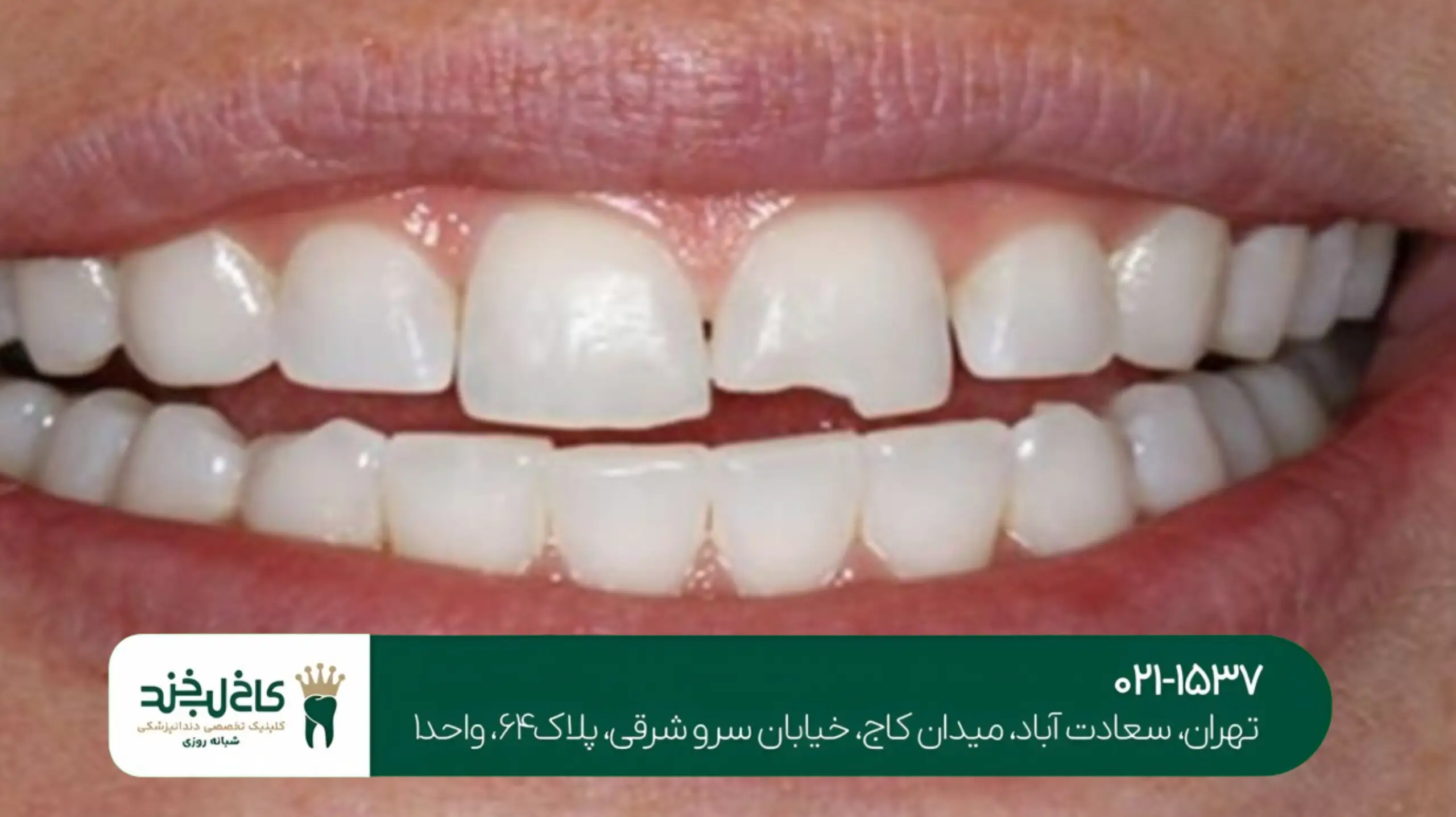 درمان شکستگی دندان تهران