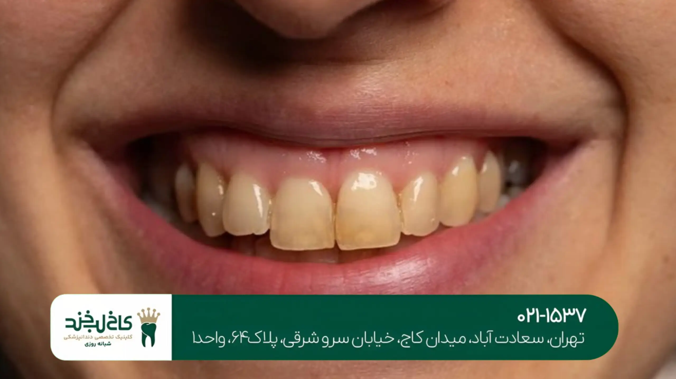 اصلاح ناهماهنگی دندان تهران