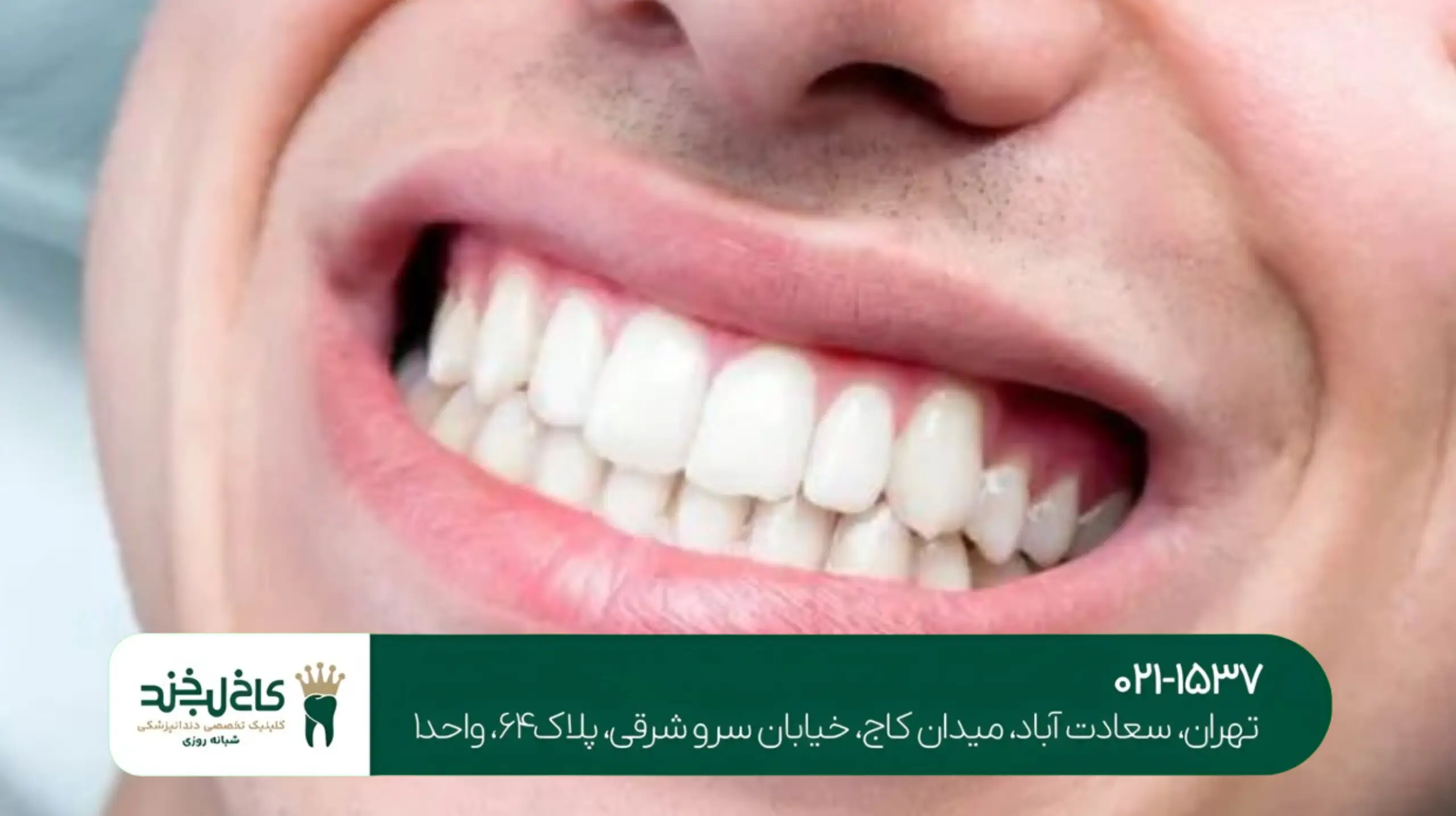 اصلاح ناهماهنگی دندان تهران