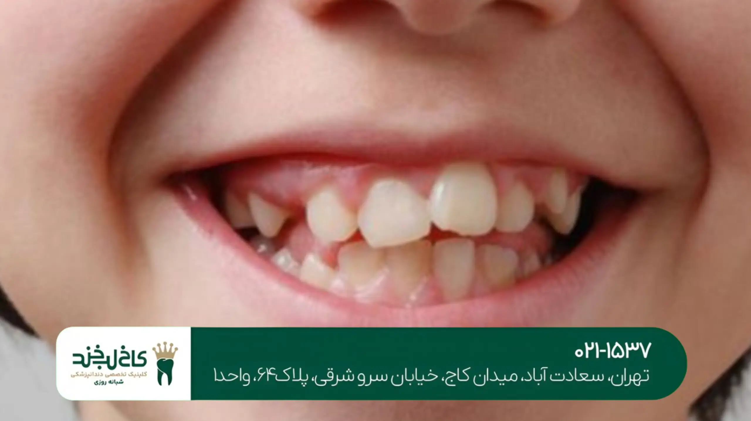 اصلاح ناهماهنگی دندان تهران