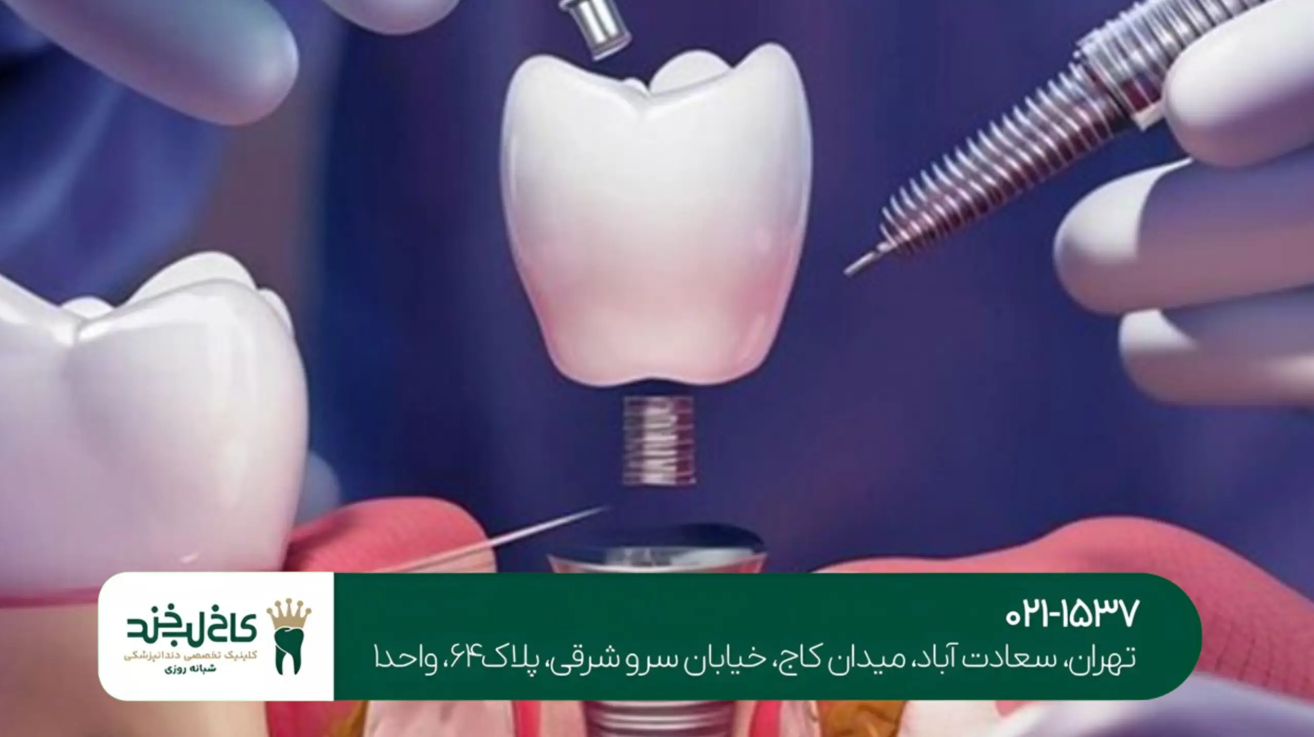 کاشت پایه دندان تهران