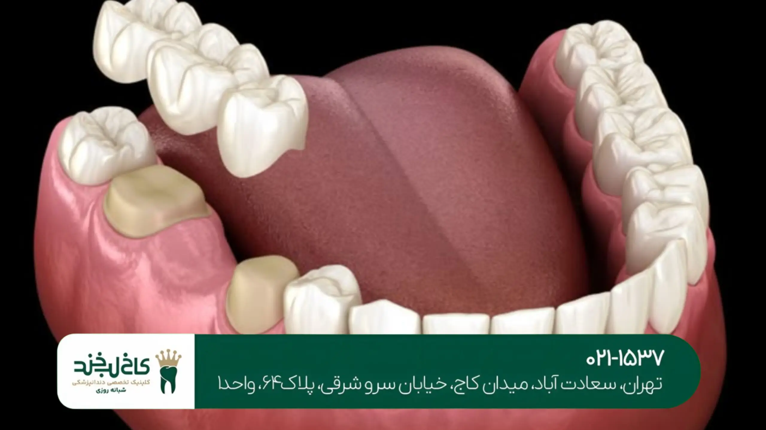 کاشت پایه دندان تهران