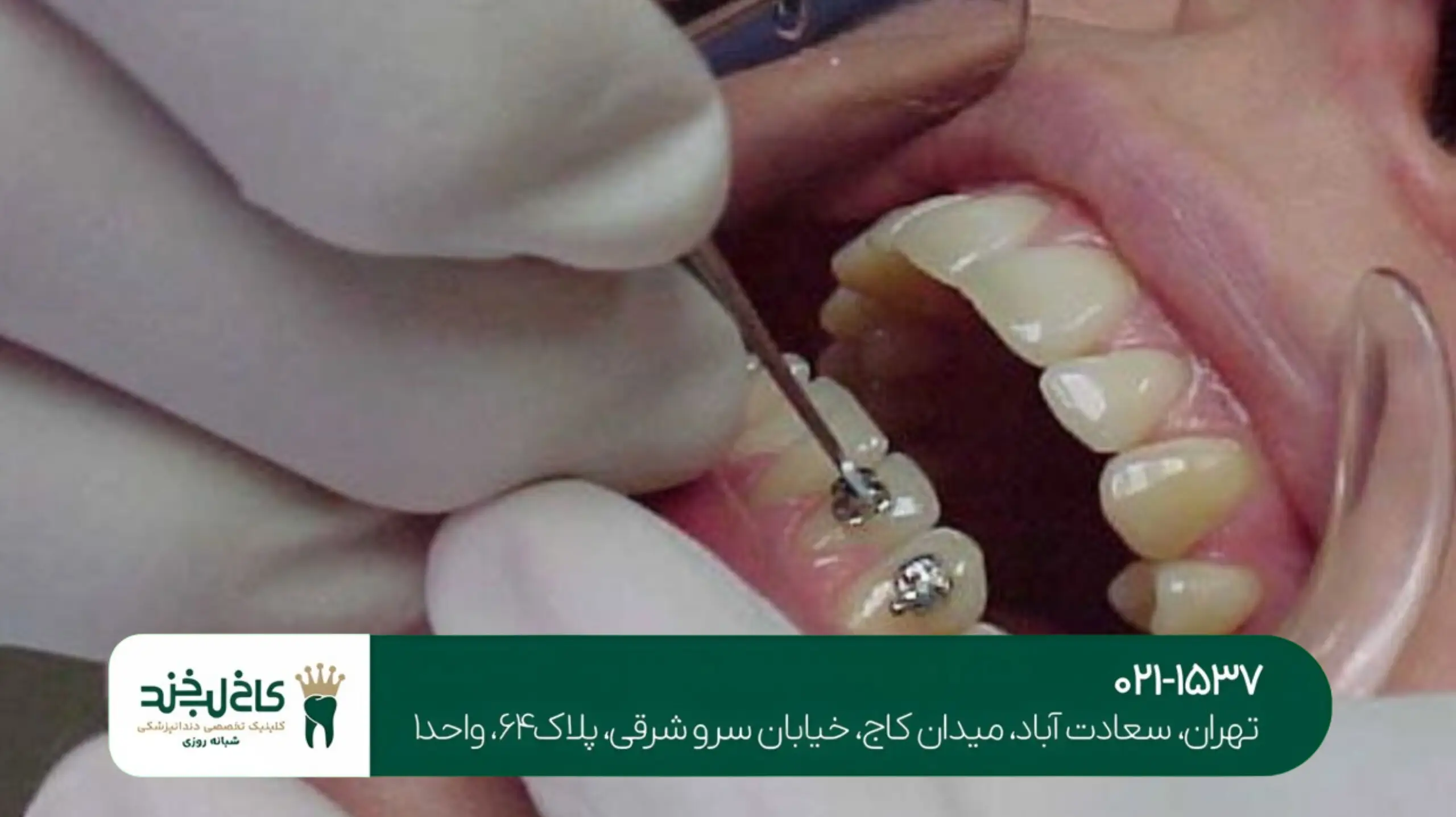 بی حسی دندان بدون سوزن تهران